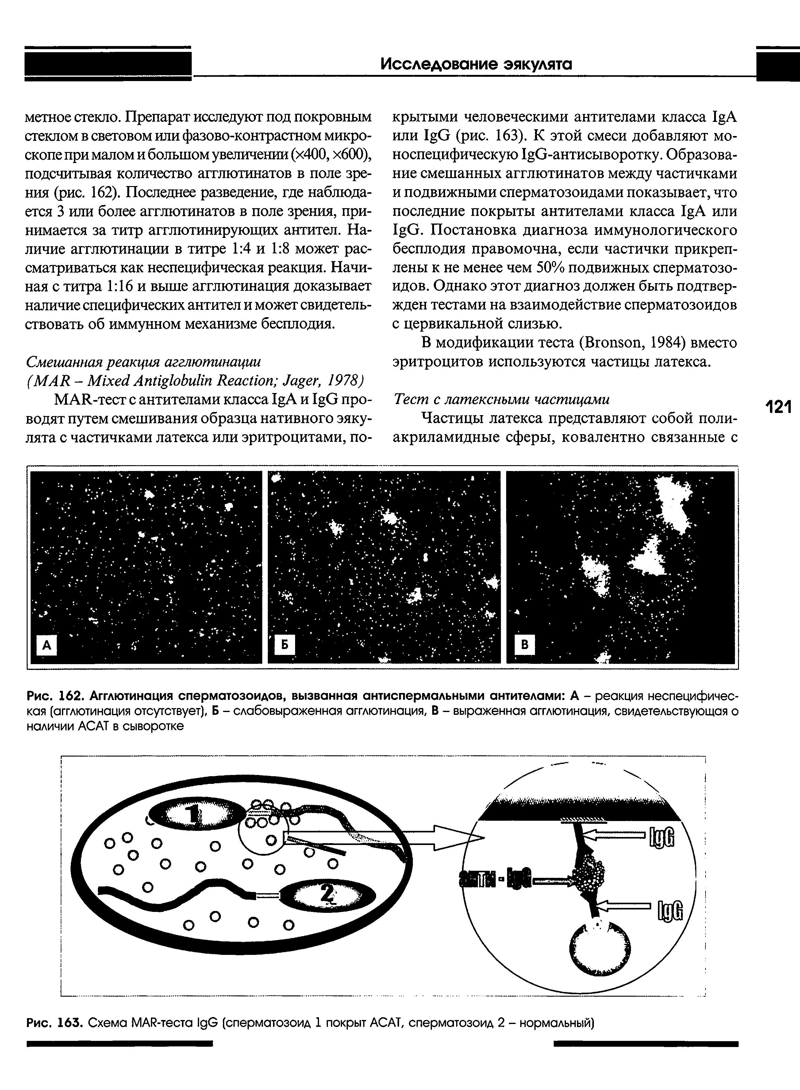 Рис. 162. Агглютинация сперматозоидов, вызванная антиспермальными антителами А - реакция неспецифическая (агглютинация отсутствует), Б - слабовыраженная агглютинация, В - выраженная агглютинация, свидетельствующая о наличии АСАТ в сыворотке...