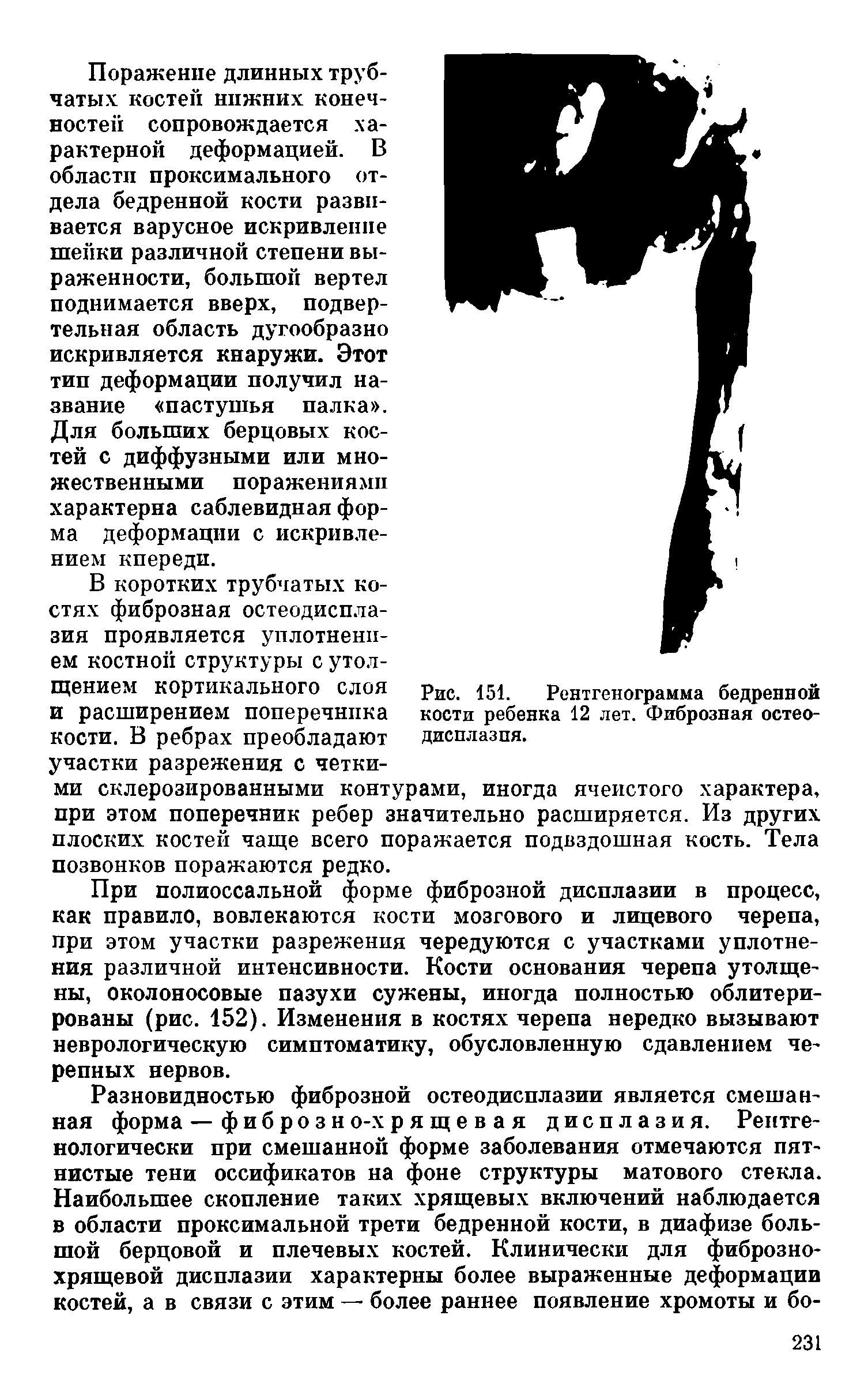 Рис. 151. Рентгенограмма бедренной кости ребенка 12 лет. Фиброзная остеодисплазия.