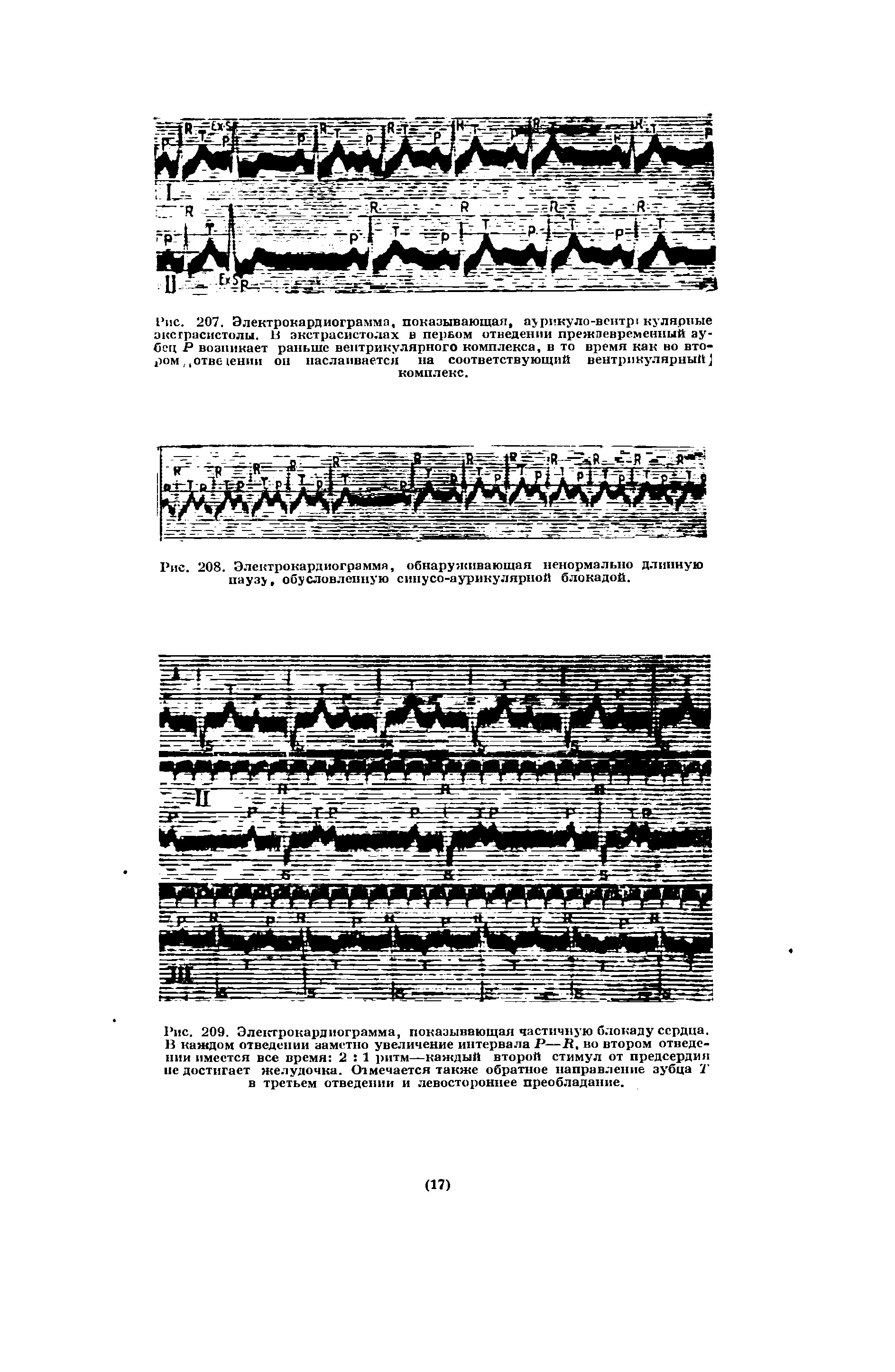 Рис. 209. Электрокардиограмма, показывающая частичную блокаду сердца. В каждом отведении заметно увеличение интервала Р—2 , во втором отведении имеется все время 2 1 ритм—каждый второй стимул от предсердия не достигает желудочка. Отмечается также обратное направление зубца Г в третьем отведении и левостороннее преобладание.