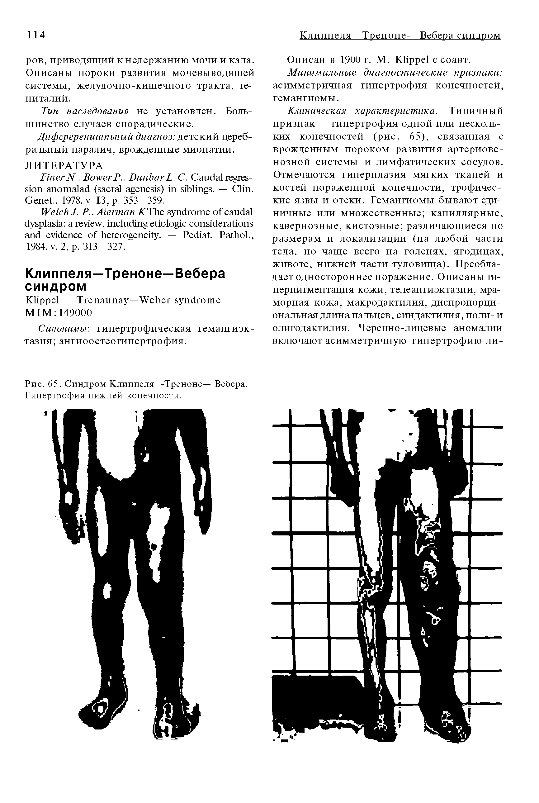 Рис. 65. Синдром Клиппеля -Треноне— Вебера. Гипертрофия нижней конечности.