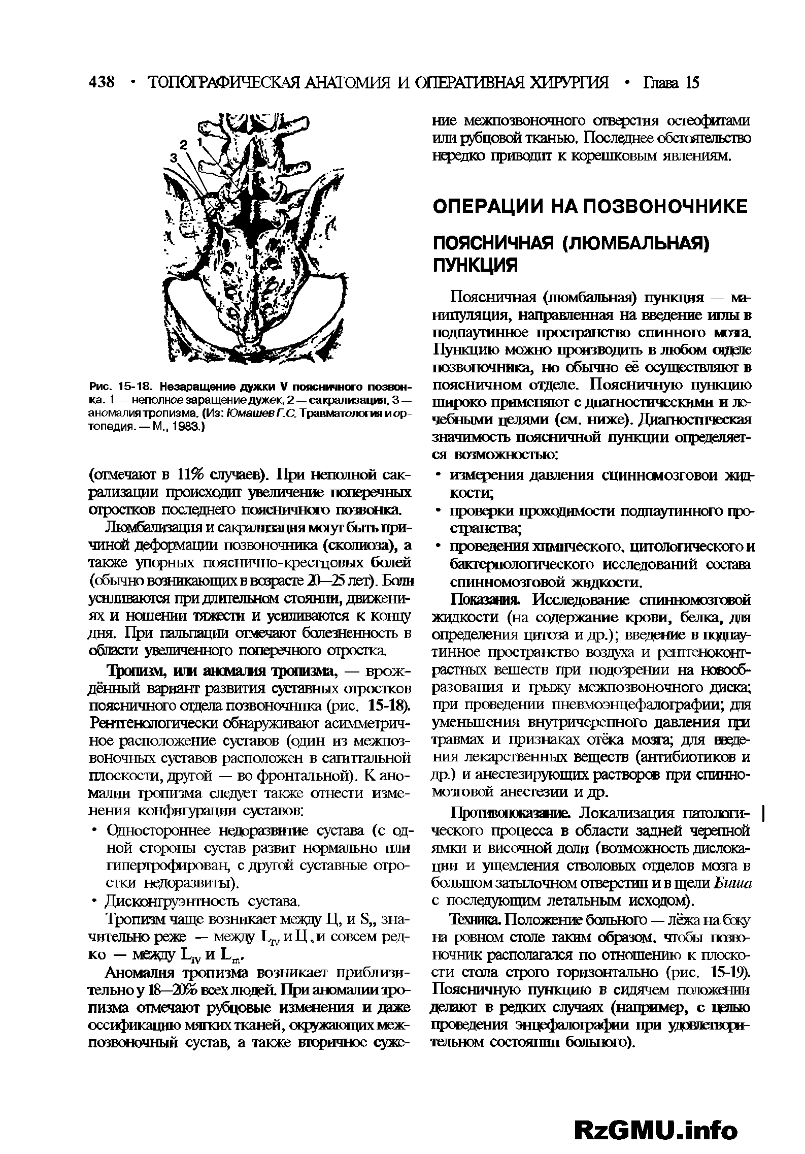 Рис. 15-18. Незаращение дужки V пояснжного позвонка. 1 — неполное заращение дужек, 2 —сакрализация, 3 — аномалия тропизма. (Из ЮмашевГ.С. Травматология и ор топедия.— М., 1983.)...