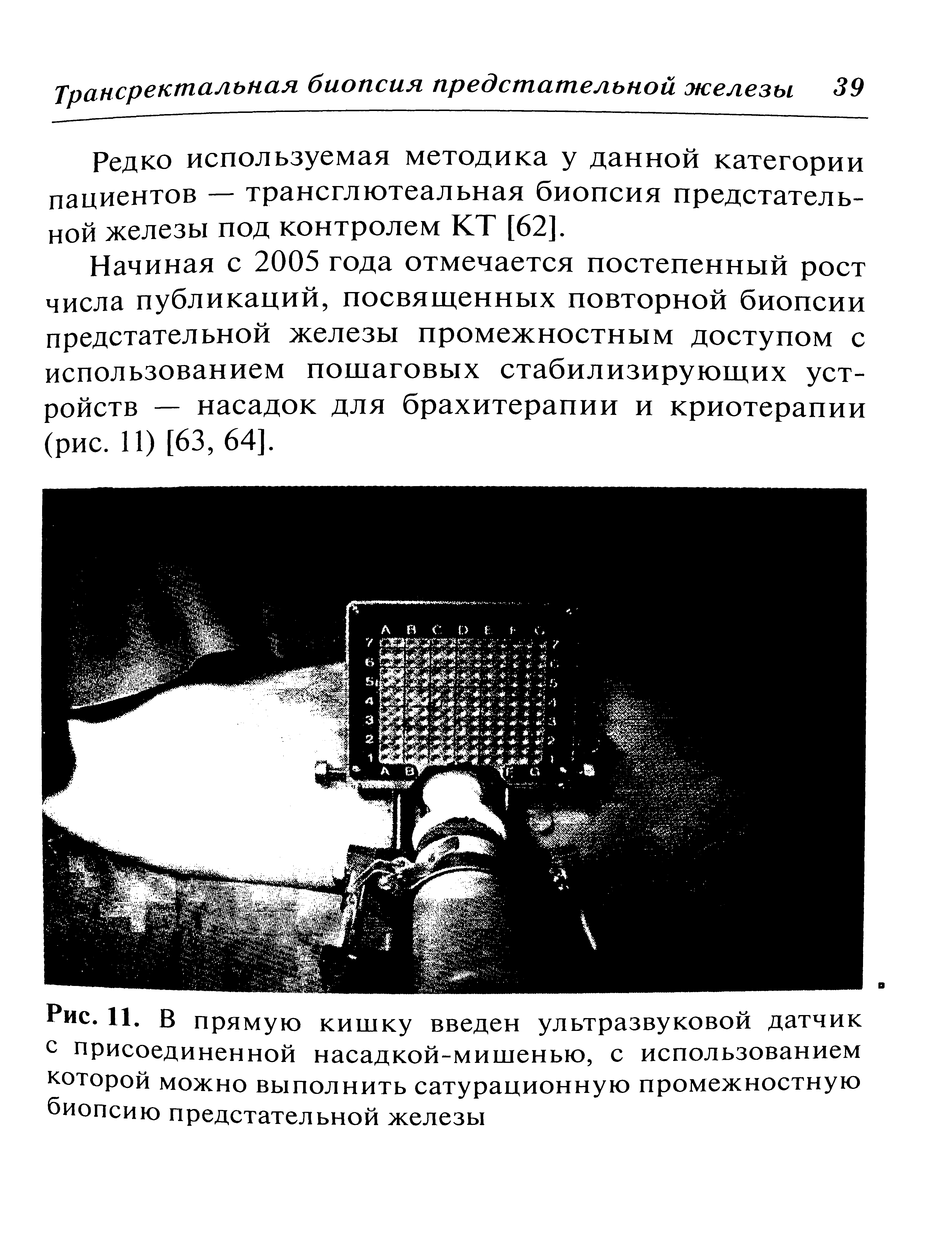 Рис. 11. В прямую кишку введен ультразвуковой датчик С присоединенной насадкой-мишенью, с использованием которой можно выполнить сатурационную промежностную биопсию предстательной железы...