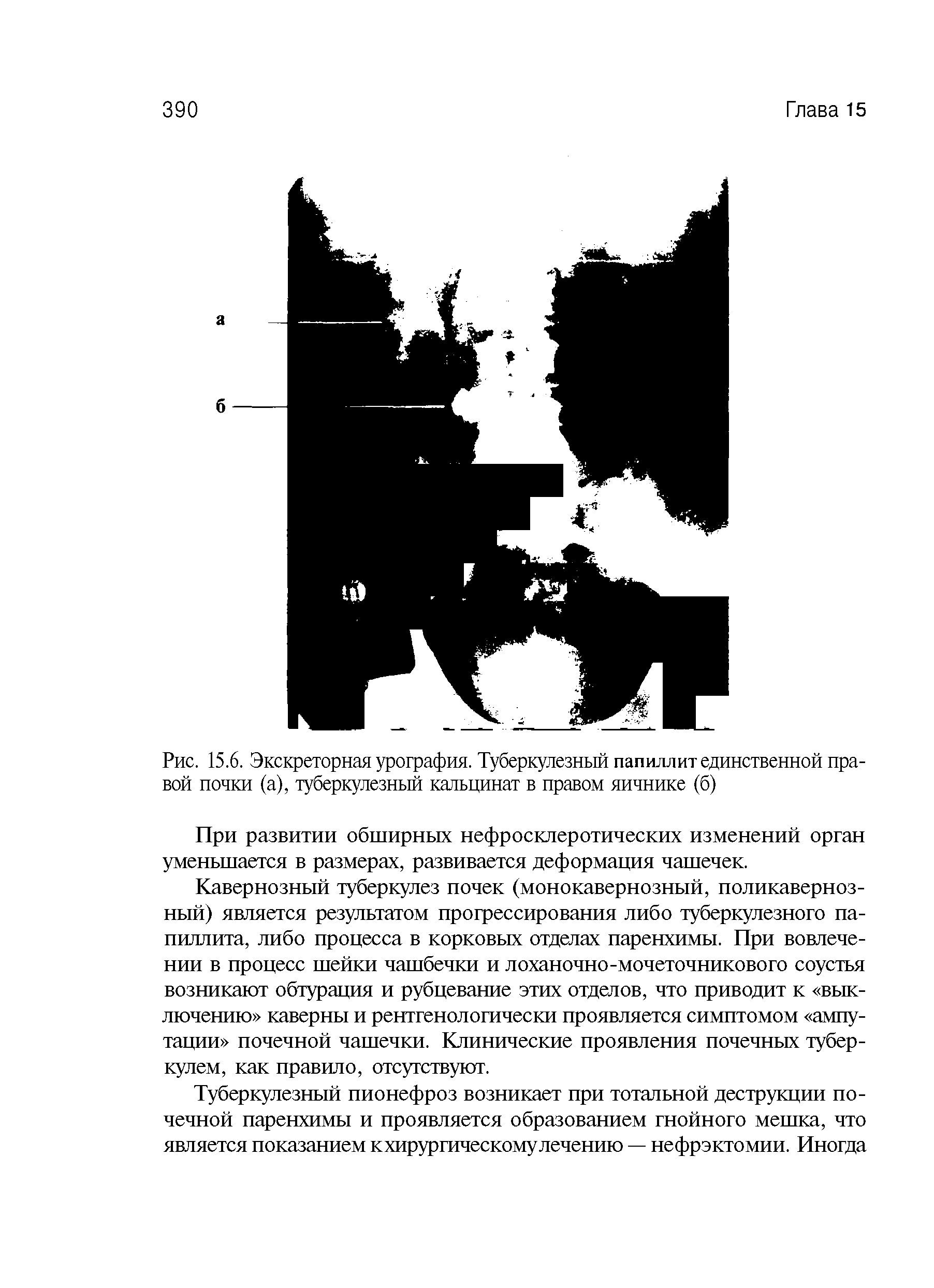 Рис. 15.6. Экскреторная урография. Туберкулезный папиллит единственной правой почки (а), туберкулезный кальцинат в правом яичнике (б)...