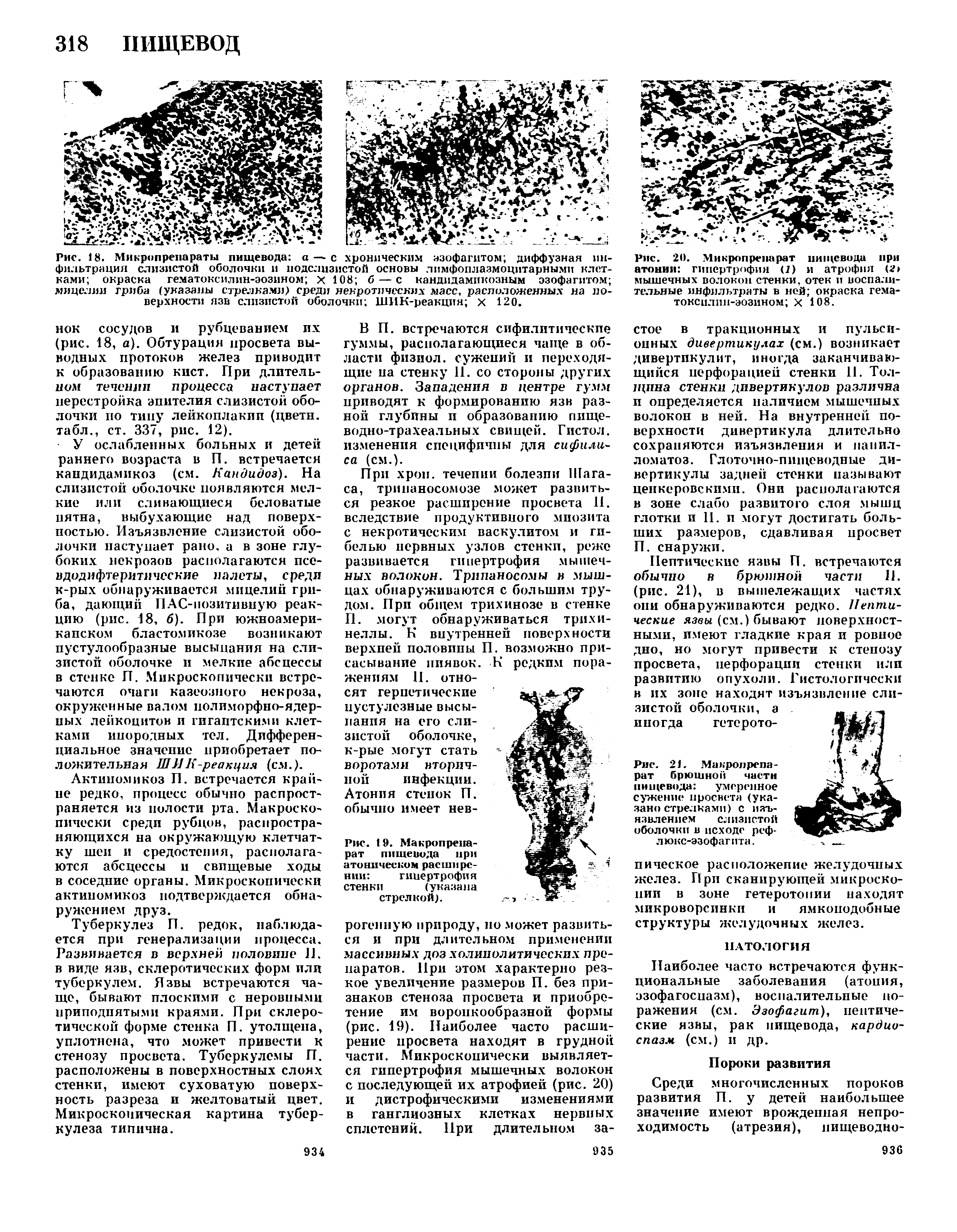 Рис. 20. Микропрепарат пищевода при атонии гипертрофия (1) и атрофия ( > мышечных волокон стенки, отек и воспалительные инфильтраты в ней окраска гема-токсилин-эозином X 108.