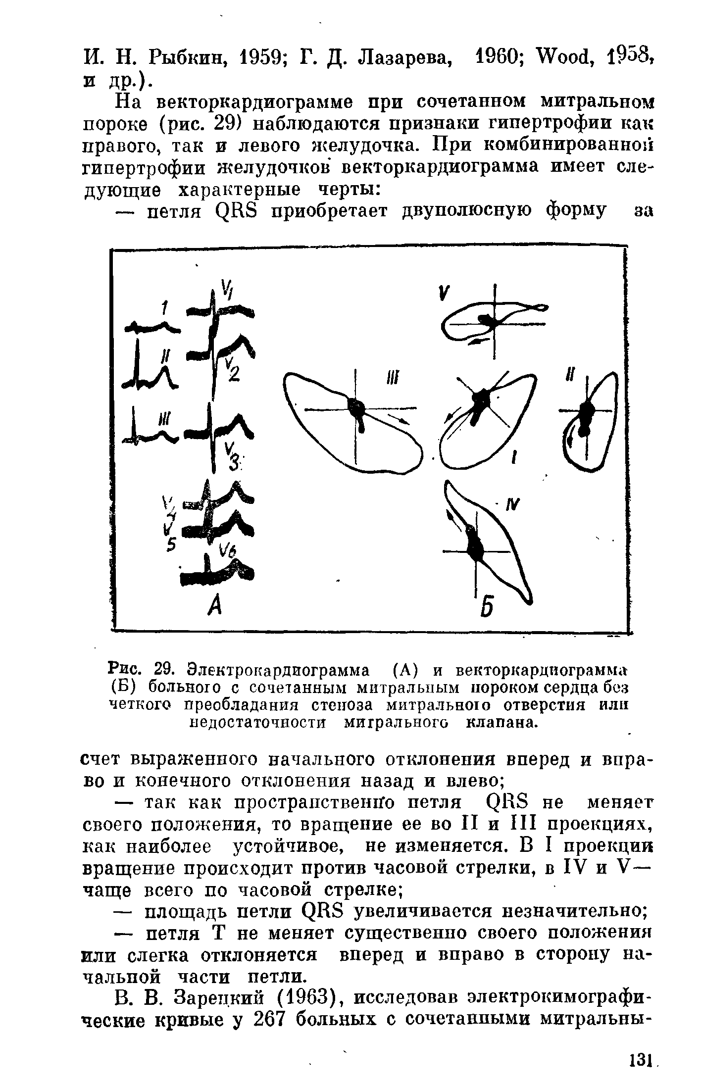 Рис. 29. Электрокардиограмма (А) и векторкардиограмма (Б) больного с сочетанным митральным пороком сердца без четкого преобладания стеноза митрального отверстия или недостаточности митрального клапана.