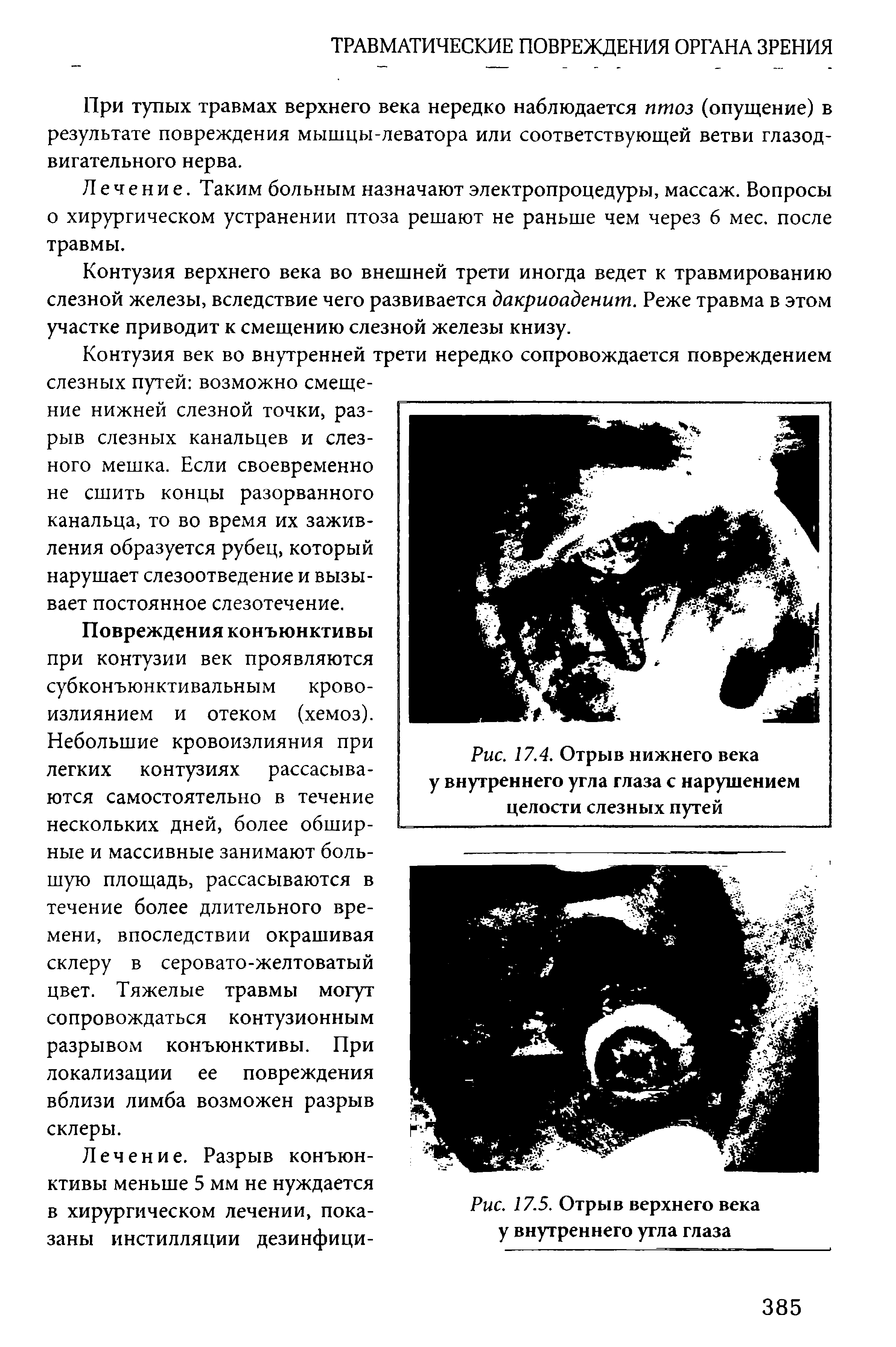 Рис. 17.4. Отрыв нижнего века у внутреннего угла глаза с нарушением целости слезных путей...