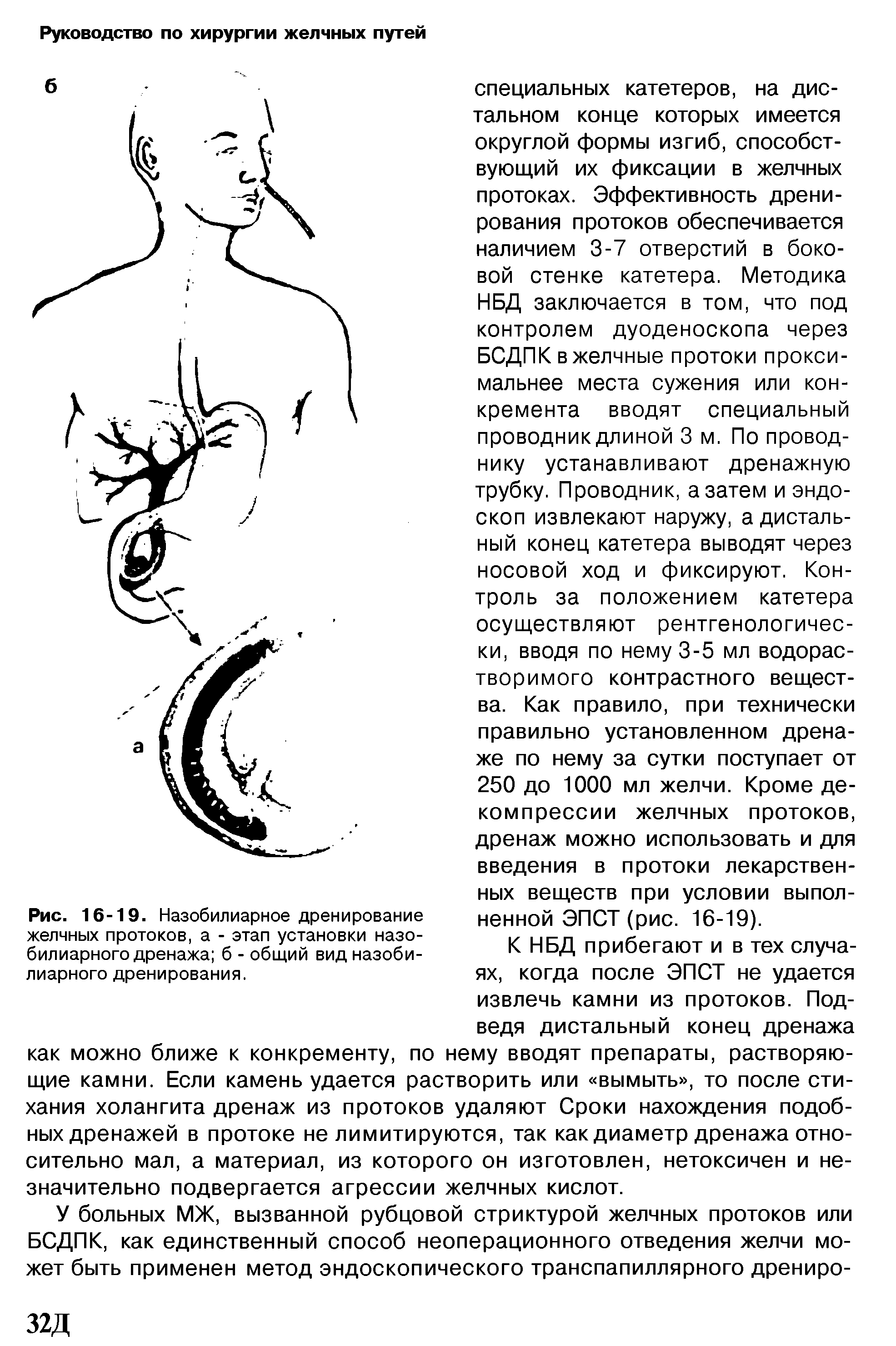 Рис. 16-19. Назобилиарное дренирование желчных протоков, а - этап установки назо-билиарного дренажа б - общий вид назоби-лиарного дренирования.