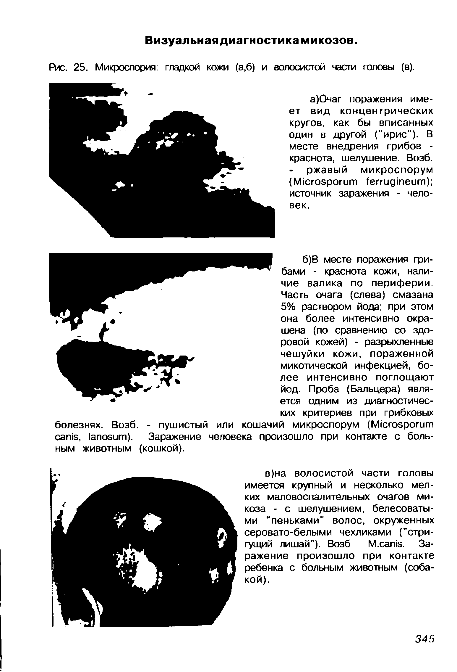 Рис. 25. Микроспория гладкой кожи (а,б) и волосистой части головы (в).