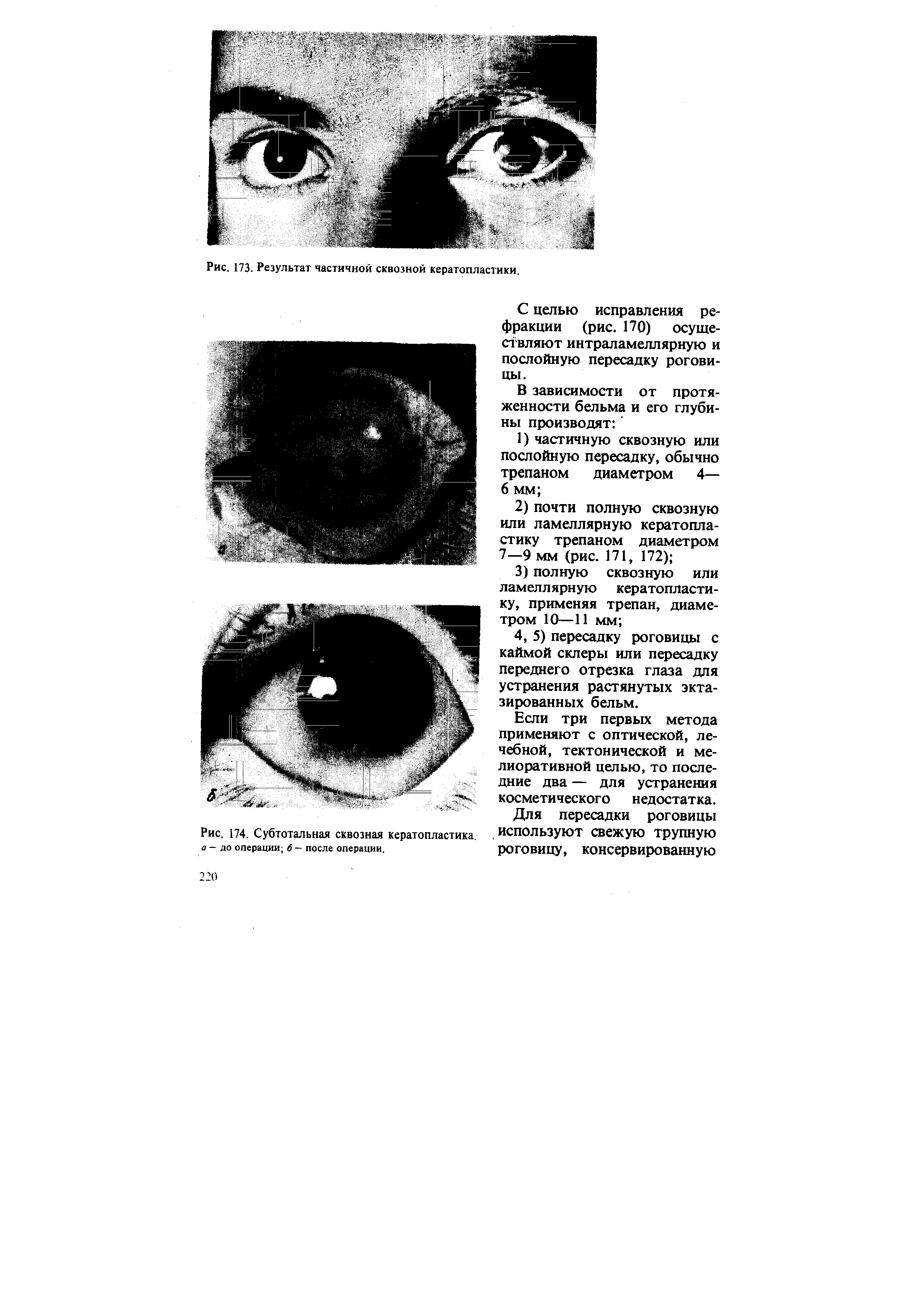 Рис. 174. Субтотальная сквозная кератопластика. а — до операции 6 — после операции.