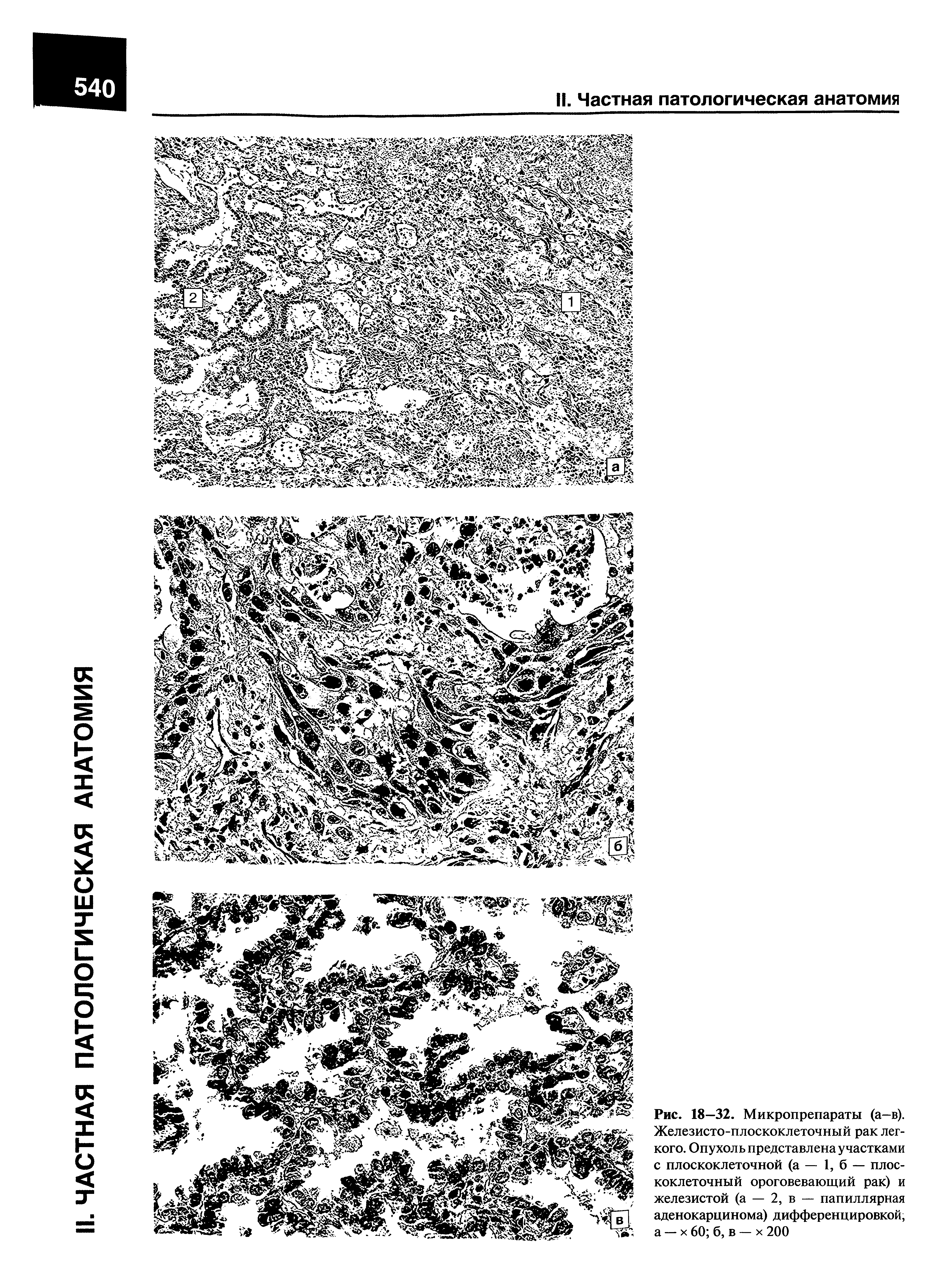 Рис. 18—32. Микропрепараты (а—в). Железисто-плоскоклеточный рак легкого. Опухоль представлена участками с плоскоклеточной (а — 1, б — плоскоклеточный ороговевающий рак) и железистой (а — 2, в — папиллярная аденокарцинома) дифференцировкой, а — х 60 б, в — х 200...