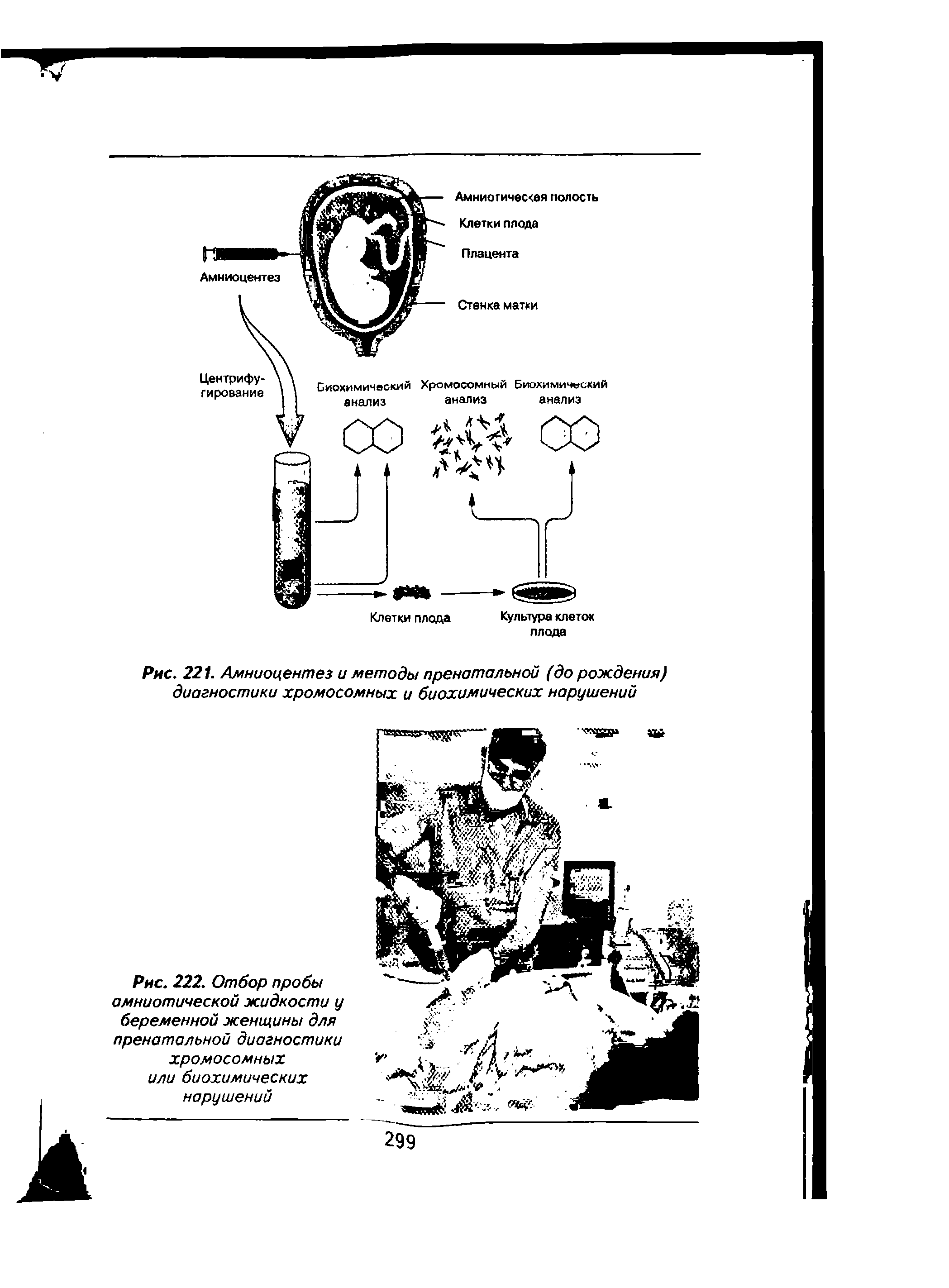 Рис. 221. Амниоцентез и методы пренатальной (до рождения) диагностики хромосомных и биохимических нарушений...