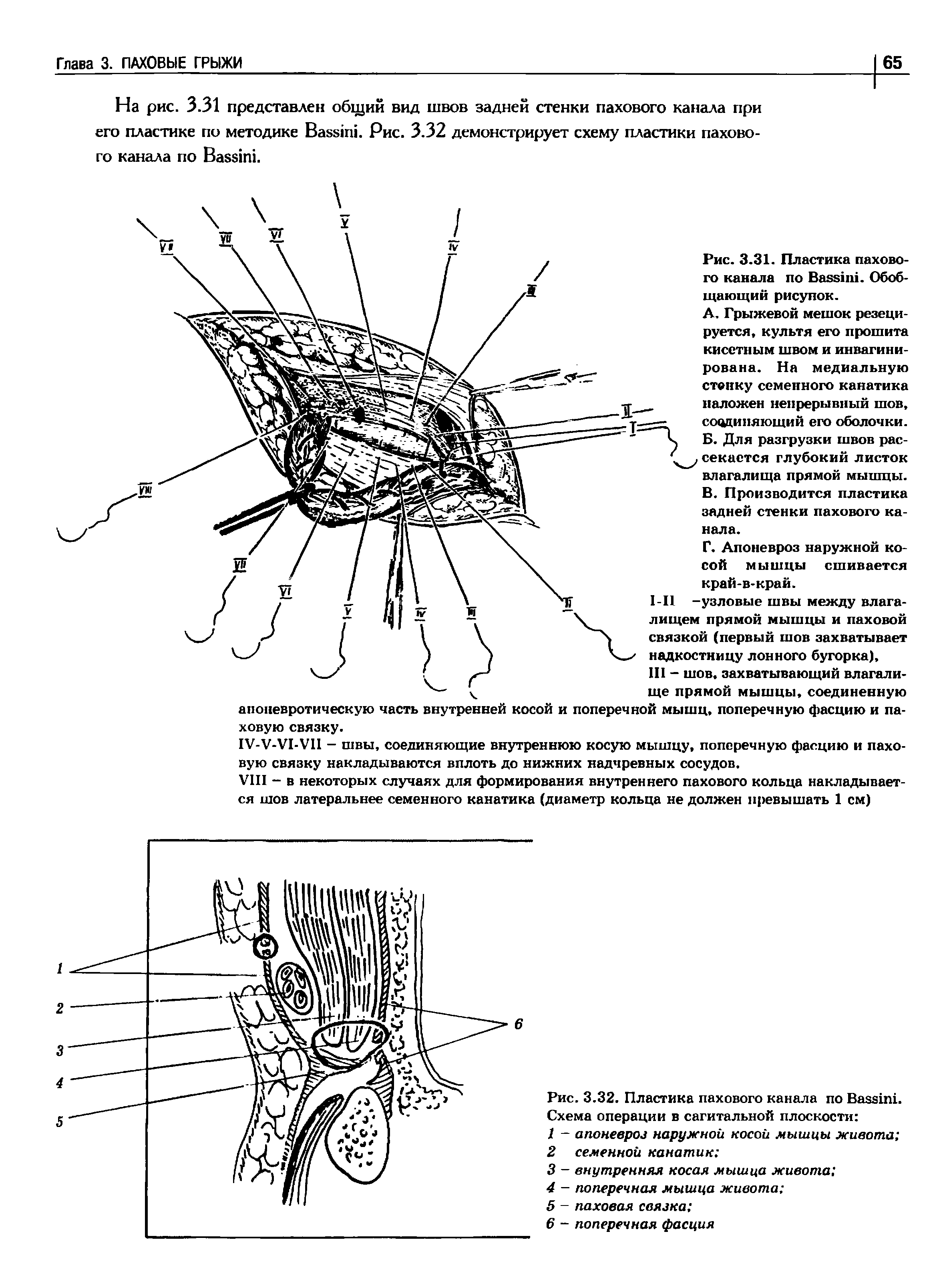 Рис. 3.31. Пластика пахового канала по B . Обобщающий рисупок.