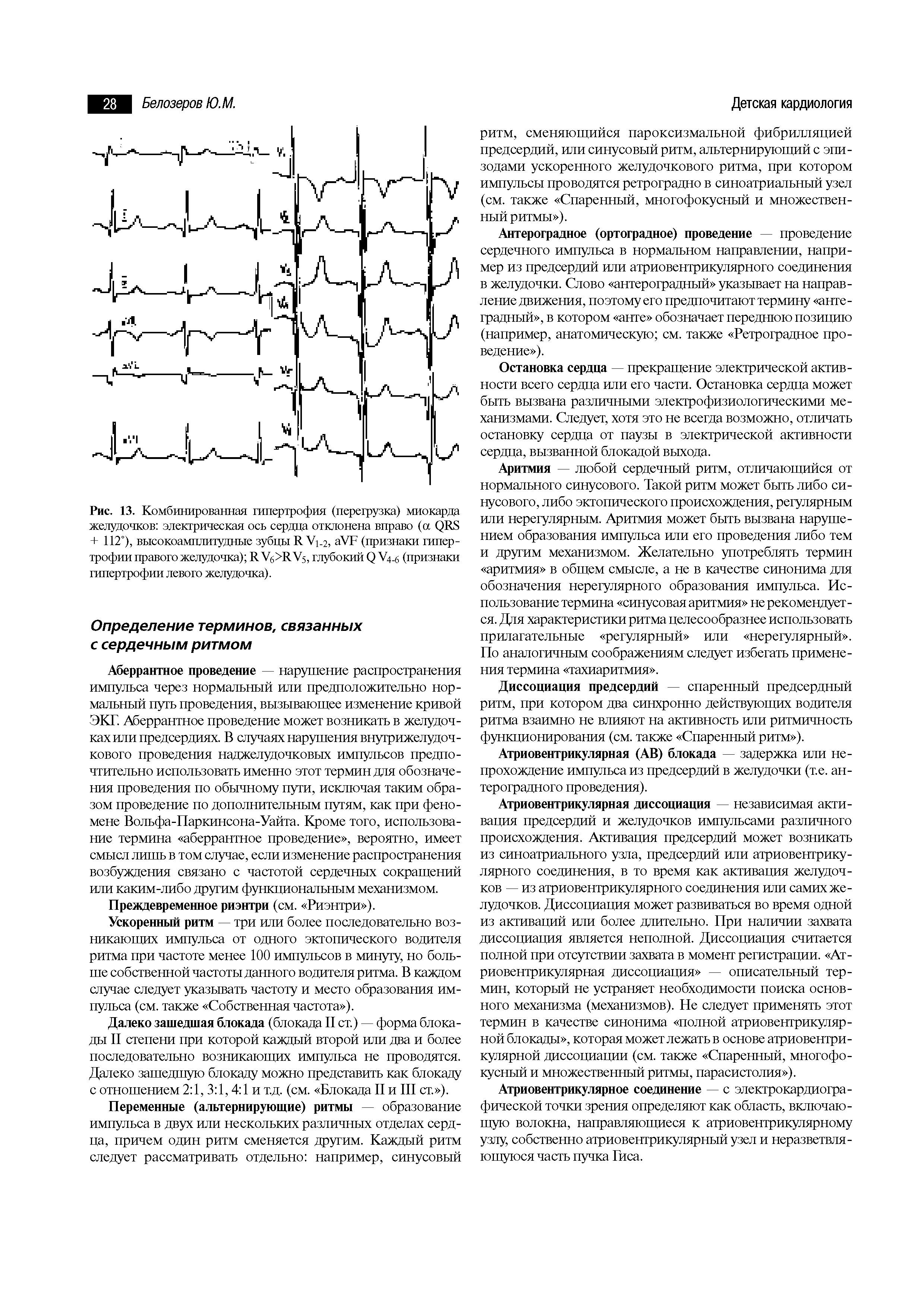 Рис. 13. Комбинированная гипертрофия (перегрузка) миокарда желудочков электрическая ось сердца отклонена вправо (а ф1 + 112°), высокоамплитудные зубцы Я Уцг, аУБ (признаки гипертрофии правого желудочка) К МдК Уф глубокий ф ц.(, (признаки гипертрофии левого желудочка).