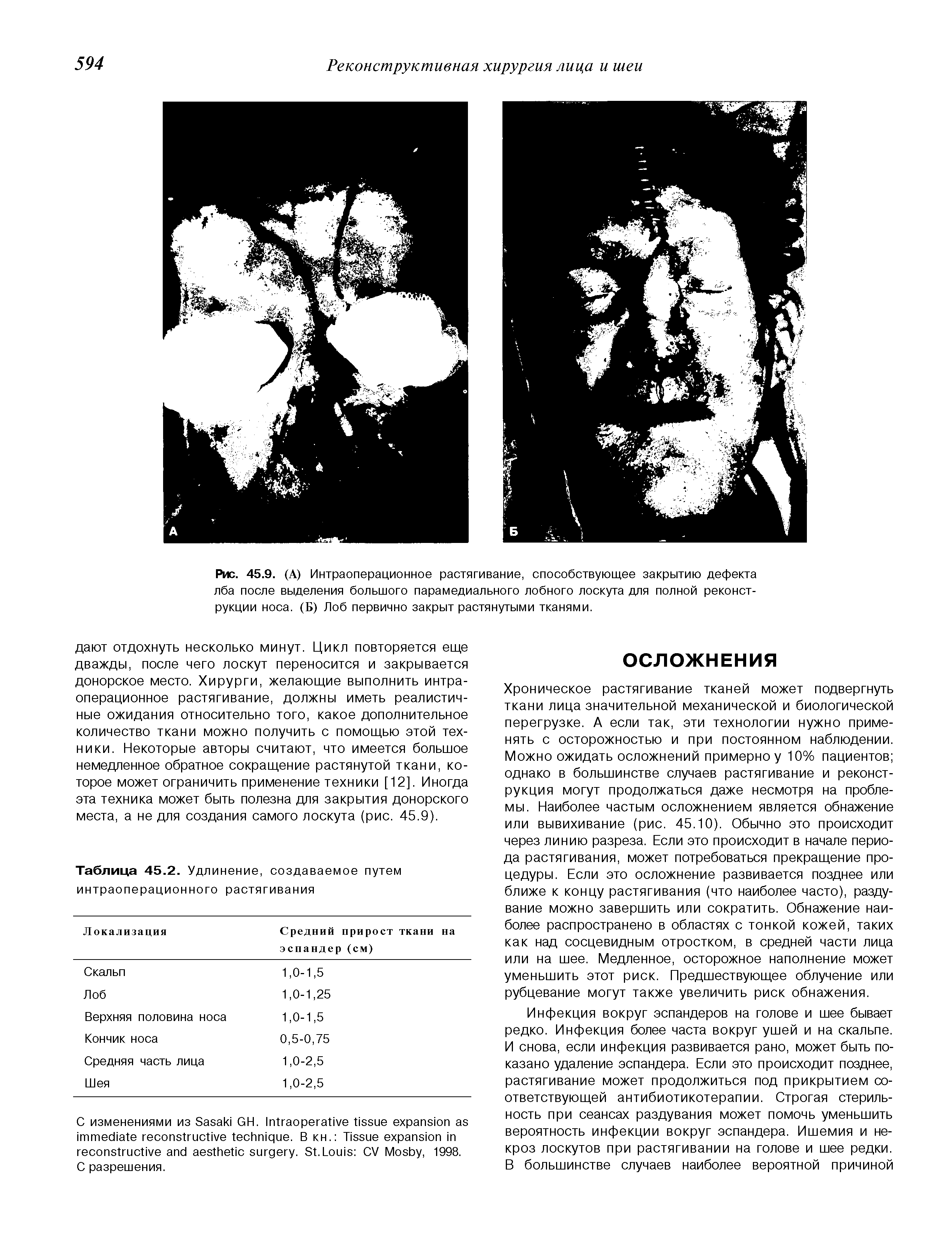 Рис. 45.9. (А) Интраоперационное растягивание, способствующее закрытию дефекта лба после выделения большого парамедиального лобного лоскута для полной реконструкции носа. (Б) Лоб первично закрыт растянутыми тканями.