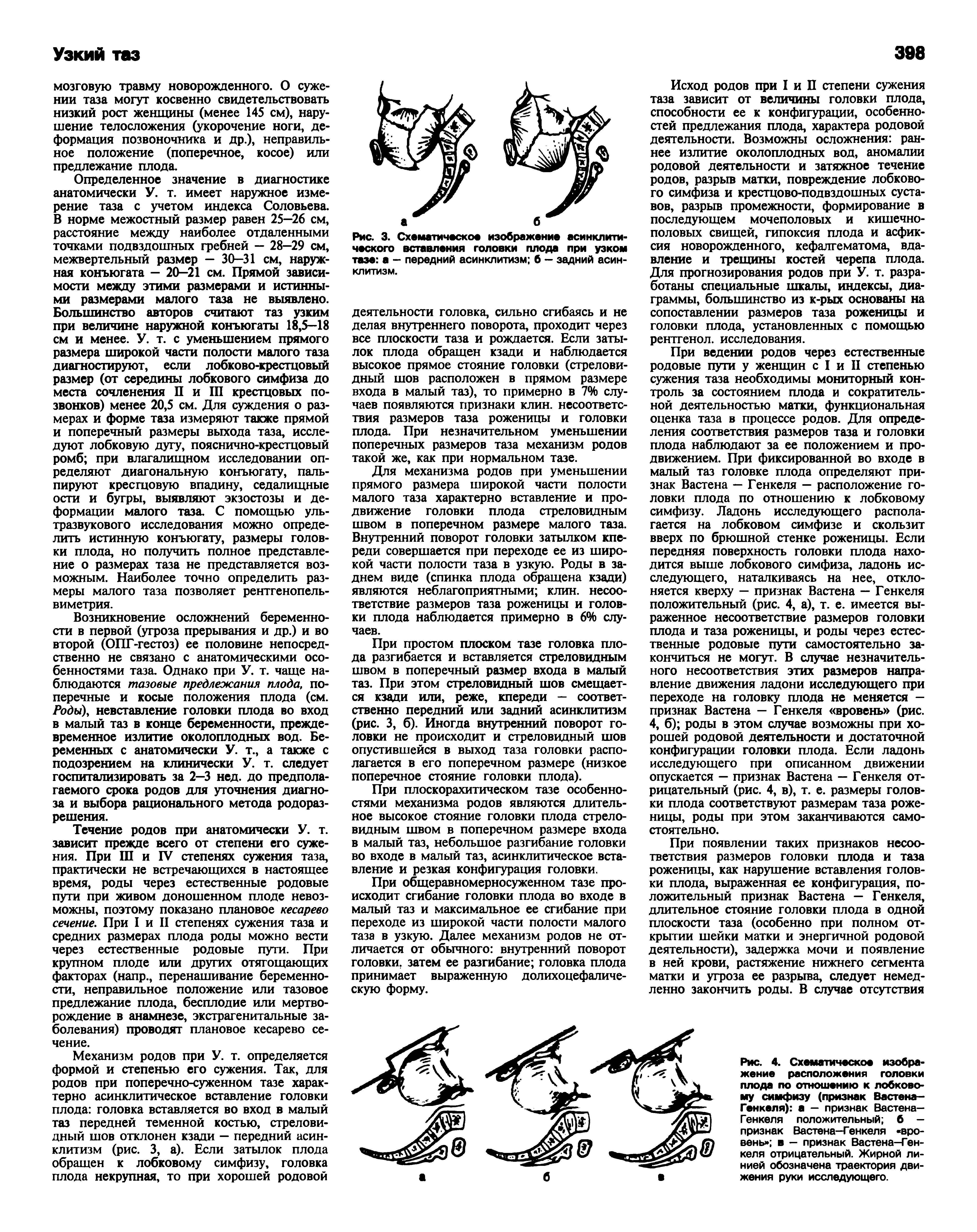 Рис. 4. Схематическое изображение расположения головки плода по отношению к лобковому симфизу (признак Вастена— Генкеля) а — признак Вастена— Генкеля положительный б -признак Вастена-Генкеля вровень в — признак Вастена—Генкеля отрицательный. Жирной линией обозначена траектория движения руки исследующего.