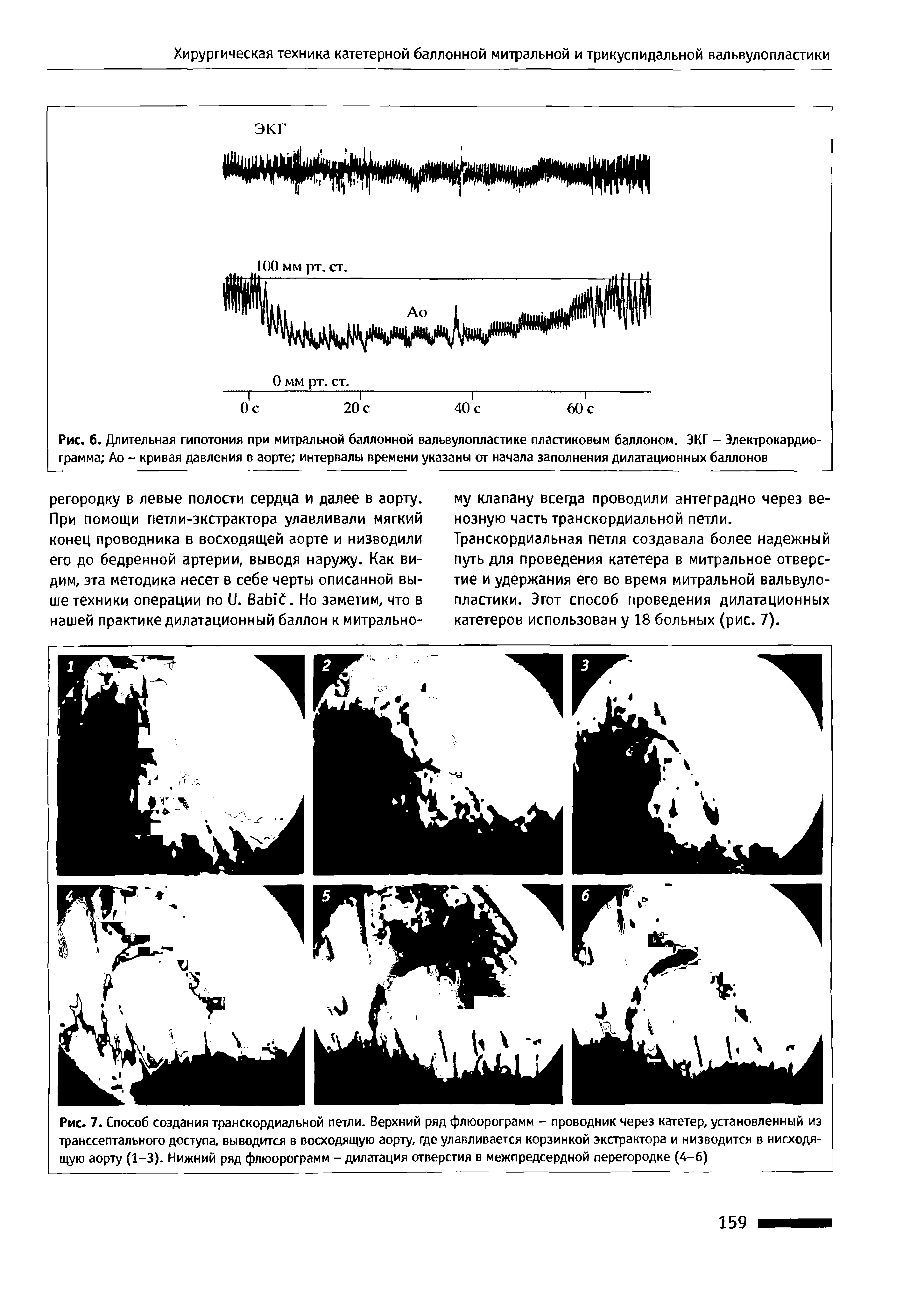 Рис. 7. Способ создания транскордиальной петли. Верхний ряд флюорограмм - проводник через катетер, установленный из транссептального доступа, выводится в восходящую аорту, где улавливается корзинкой экстрактора и низводится в нисходящую аорту (1-3). Нижний ряд флюорограмм - дилатация отверстия в межпредсердной перегородке (4-6)...