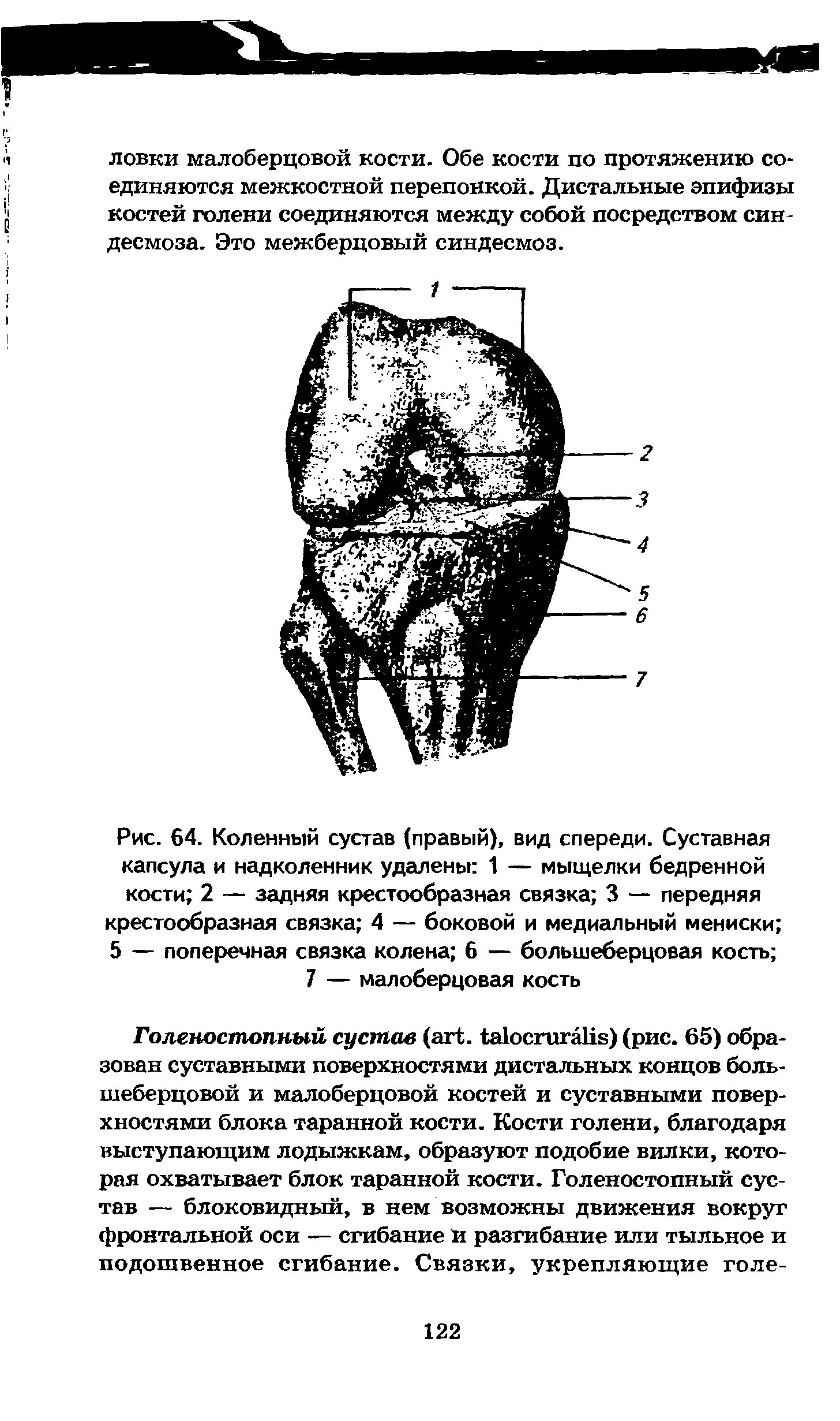 Рис. 64. Коленный сустав (правый), вид спереди. Суставная капсула и надколенник удалены 1 — мыщелки бедренной кости 2 — задняя крестообразная связка 3 — передняя крестообразная связка 4 — боковой и медиальный мениски 5 — поперечная связка колена 6 — большеберцовая кость ...