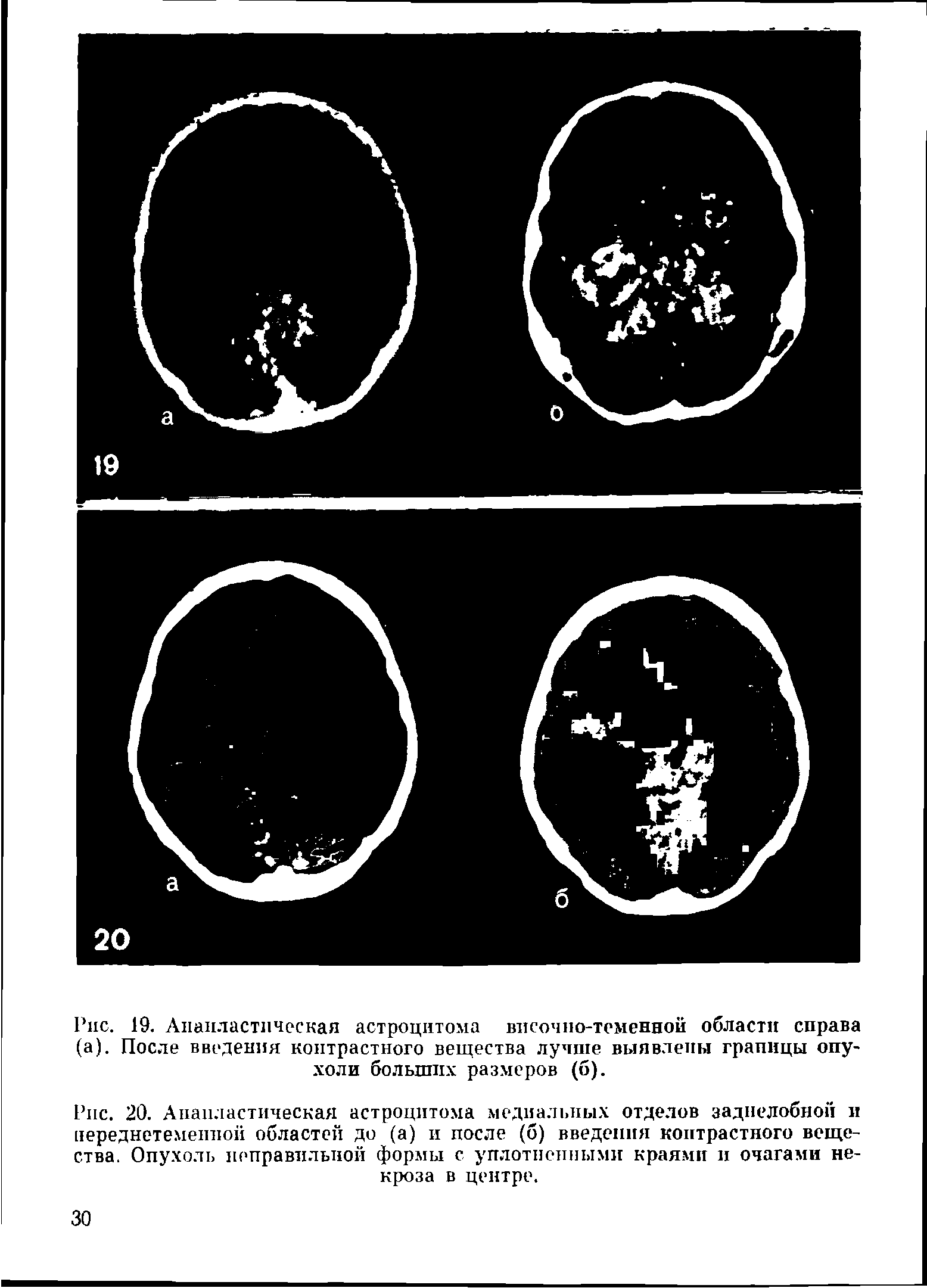 Рис. 20. Анапластическая астроцитома медиальных отделов заднелобной и переднетемеппоп областей до (а) и после (б) введения контрастного вещества. Опухоль неправильной формы с уплотненными краями и очагами некроза в центре.