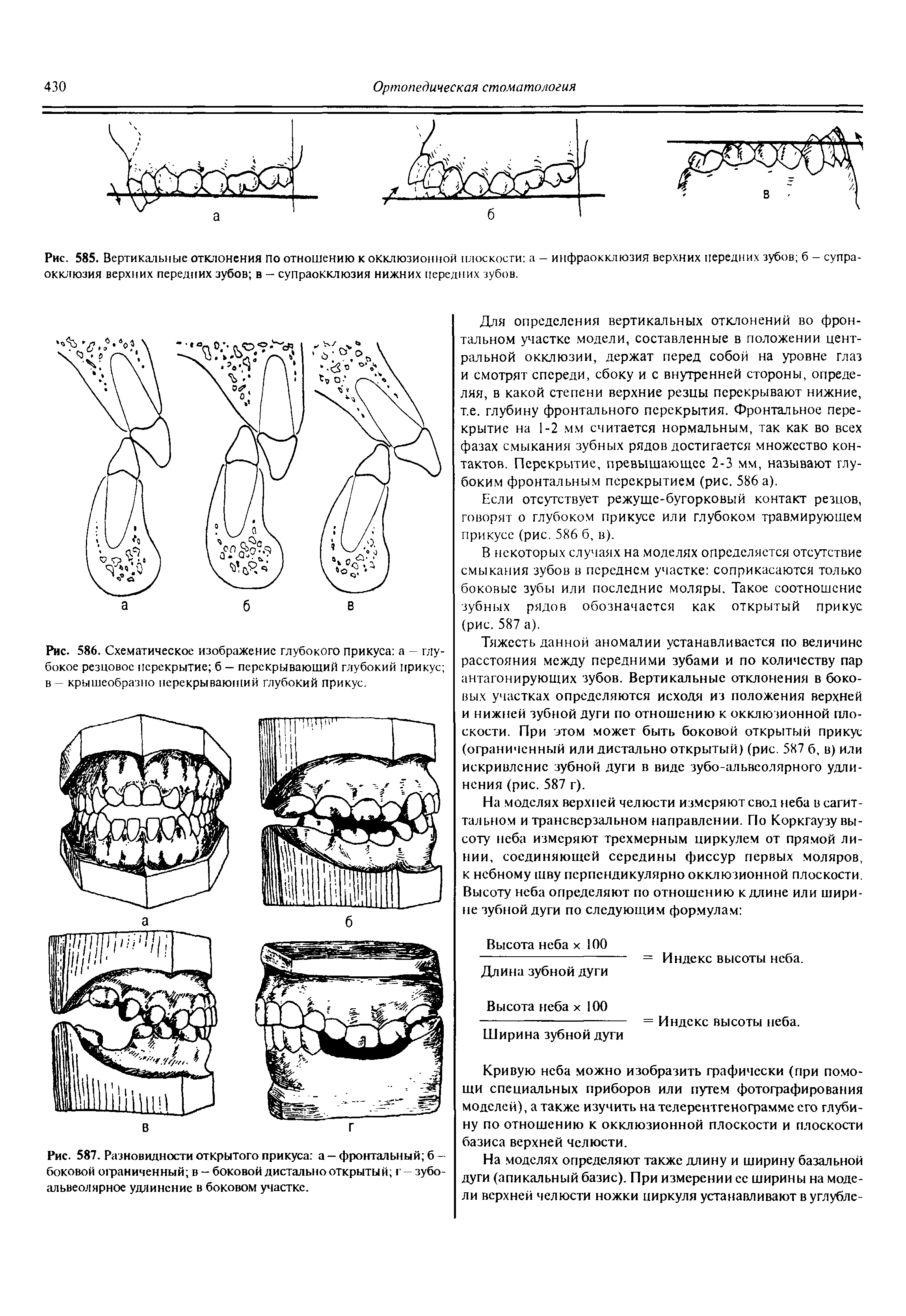 Рис. 586. Схематическое изображение глубокого прикуса а - глубокое резцовое перекрытие б — перекрывающий глубокий прикус в - крышеобразно перекрывающий глубокий прикус.