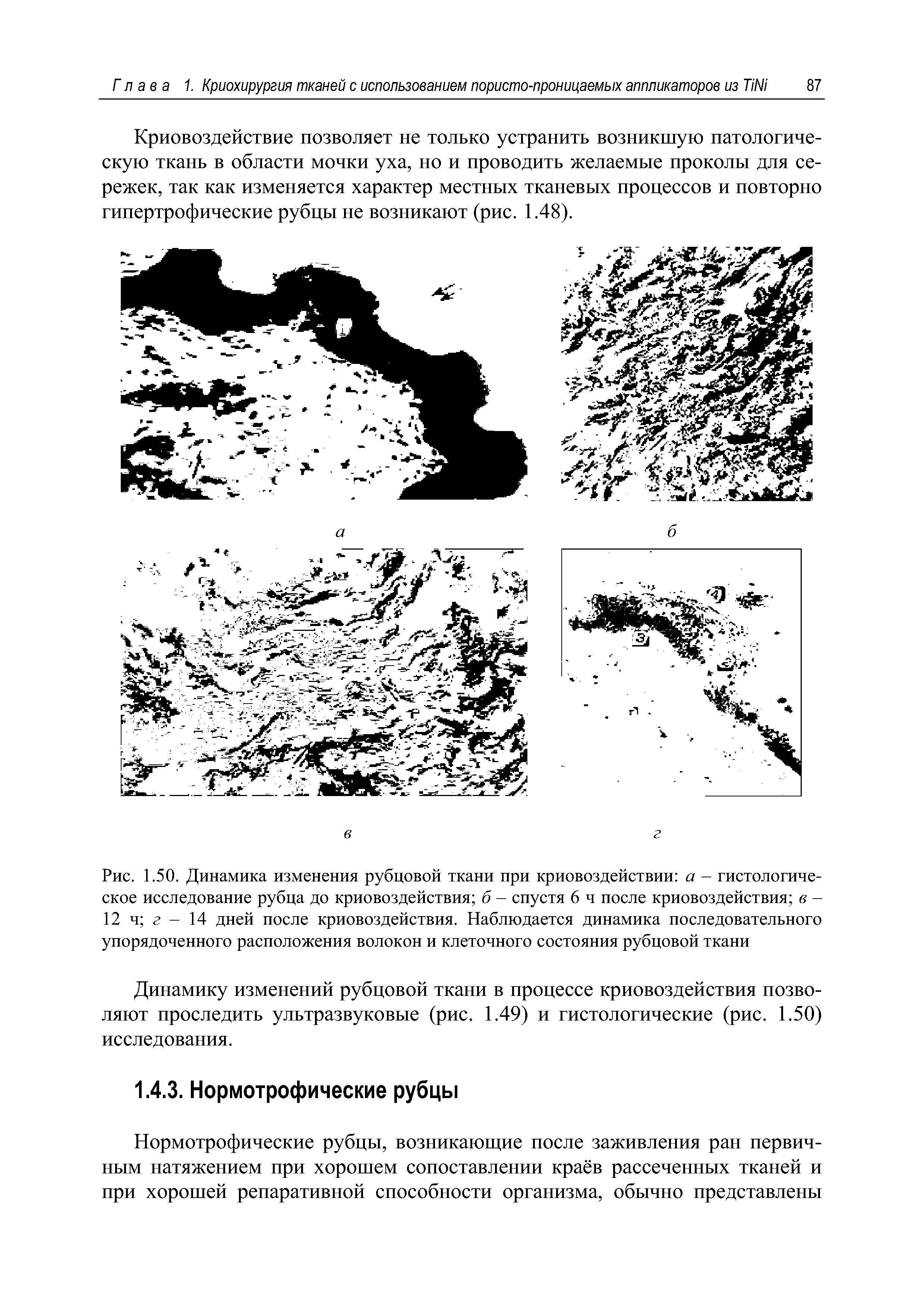 Рис. 1.50. Динамика изменения рубцовой ткани при криовоздействии а - гистологическое исследование рубца до криовоздействия б - спустя 6 ч после криовоздействия в -12 ч г - 14 дней после криовоздействия. Наблюдается динамика последовательного упорядоченного расположения волокон и клеточного состояния рубцовой ткани...