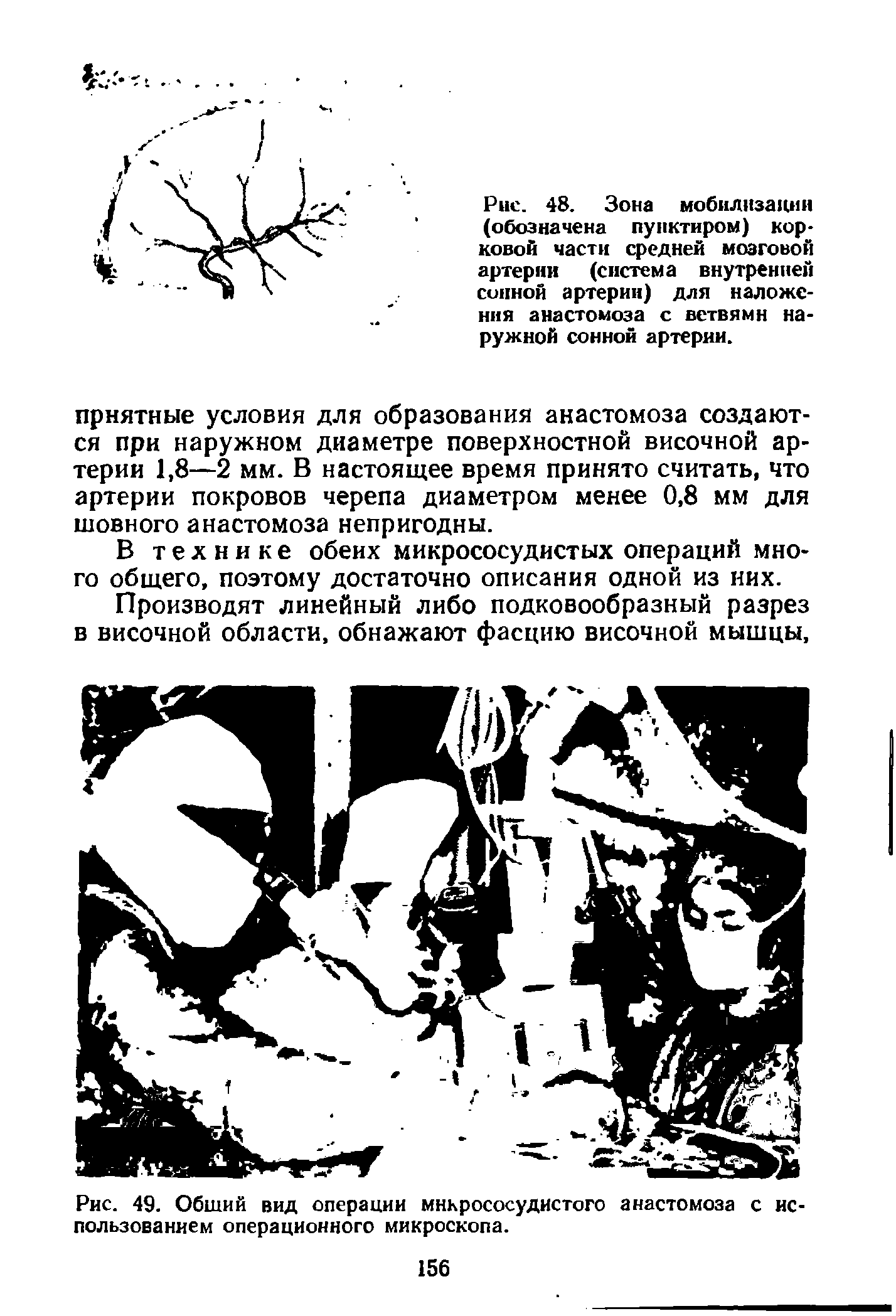 Рис. 48. Зона мобилизации (обозначена пунктиром) корковой части средней мозговой артерии (система внутренней сонной артерии) для наложения анастомоза с ветвями наружной сонной артерии.