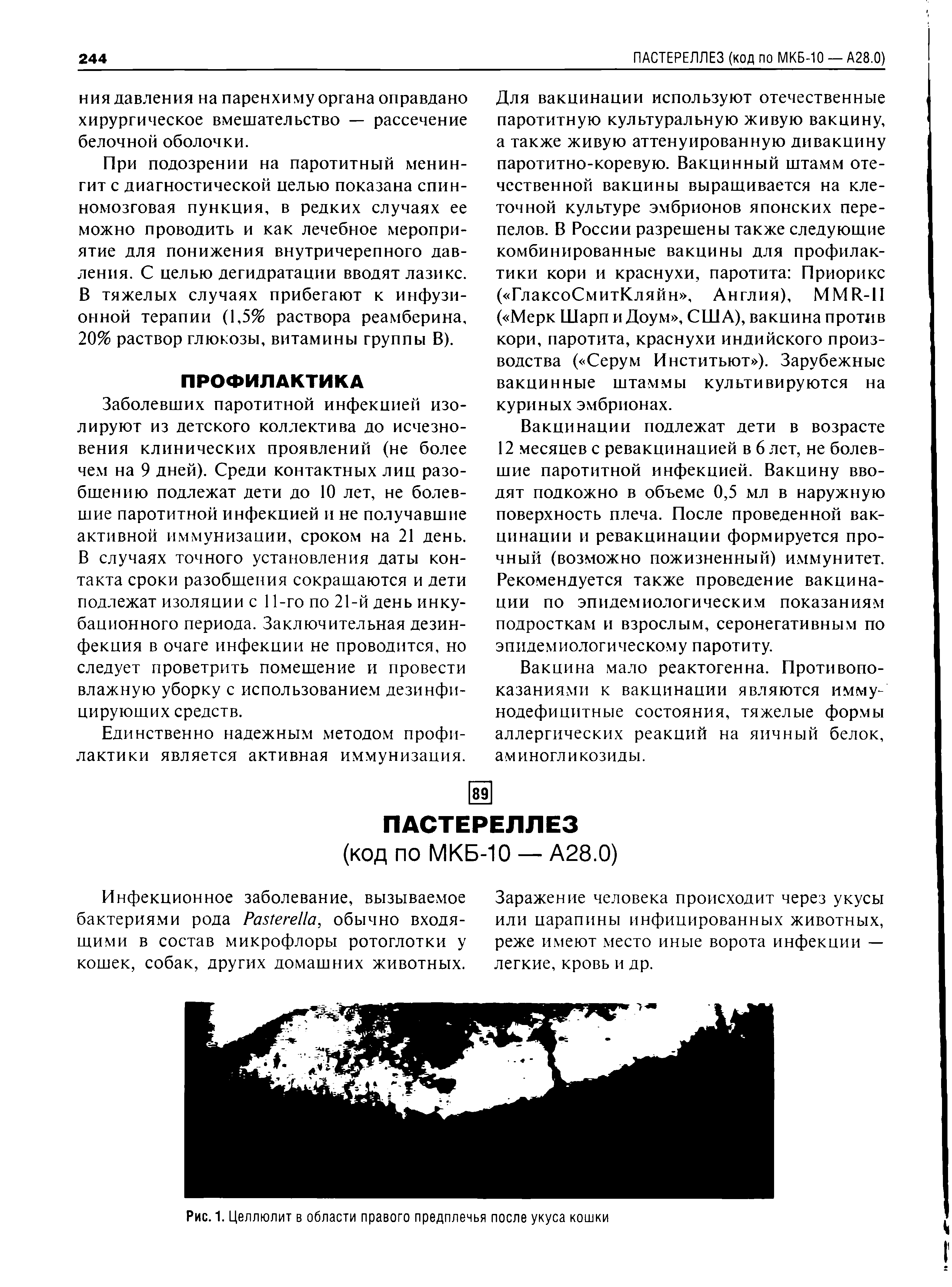 Рис. 1. Целлюлит в области правого предплечья после укуса кошки...