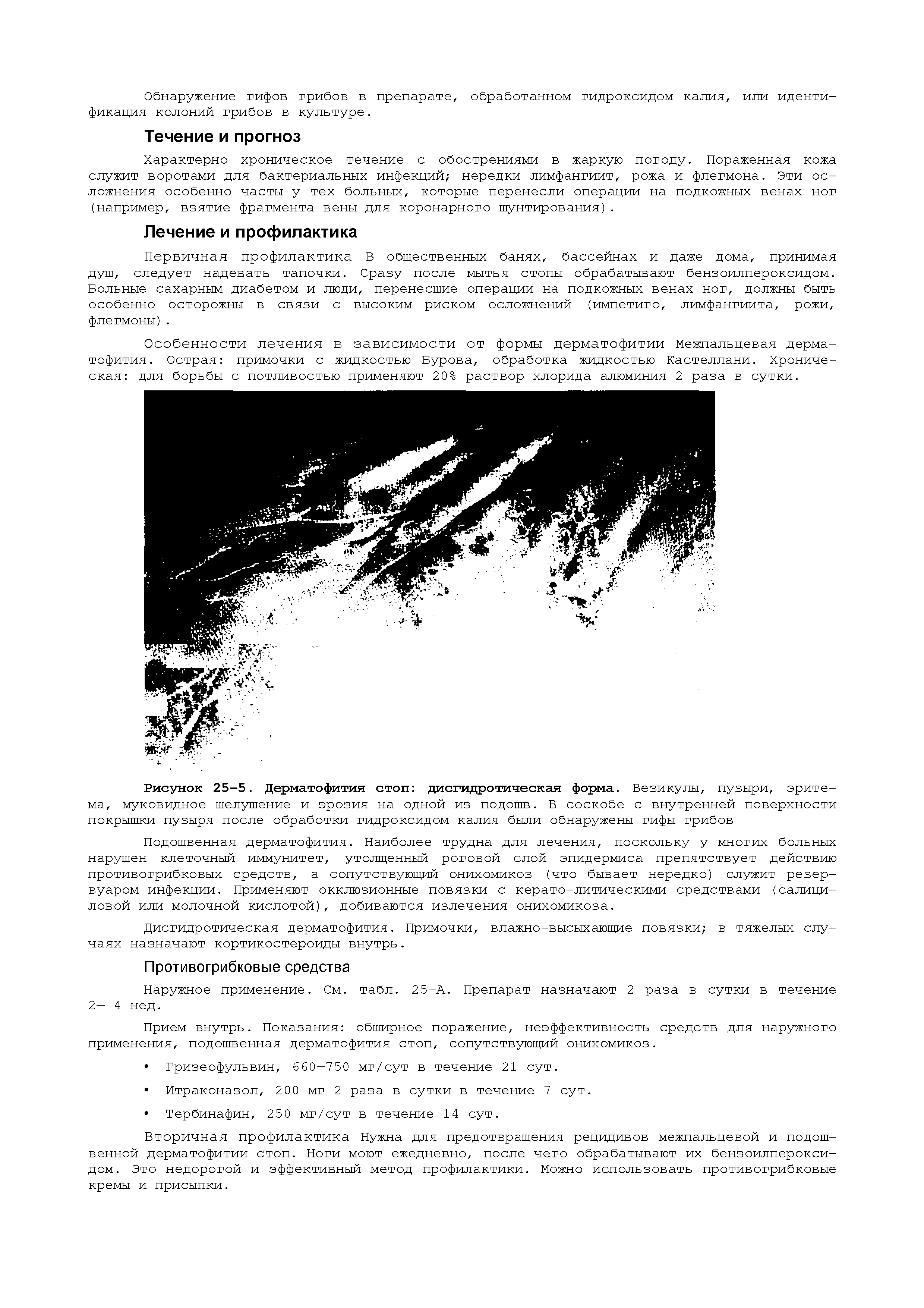 Рисунок 25-5. Дерматофития стоп дисгидротическая форма. Везикулы, пузыри, эритема, муковидное шелушение и эрозия на одной из подошв. В соскобе с внутренней поверхности покрышки пузыря после обработки гидроксидом калия были обнаружены гифы грибов...