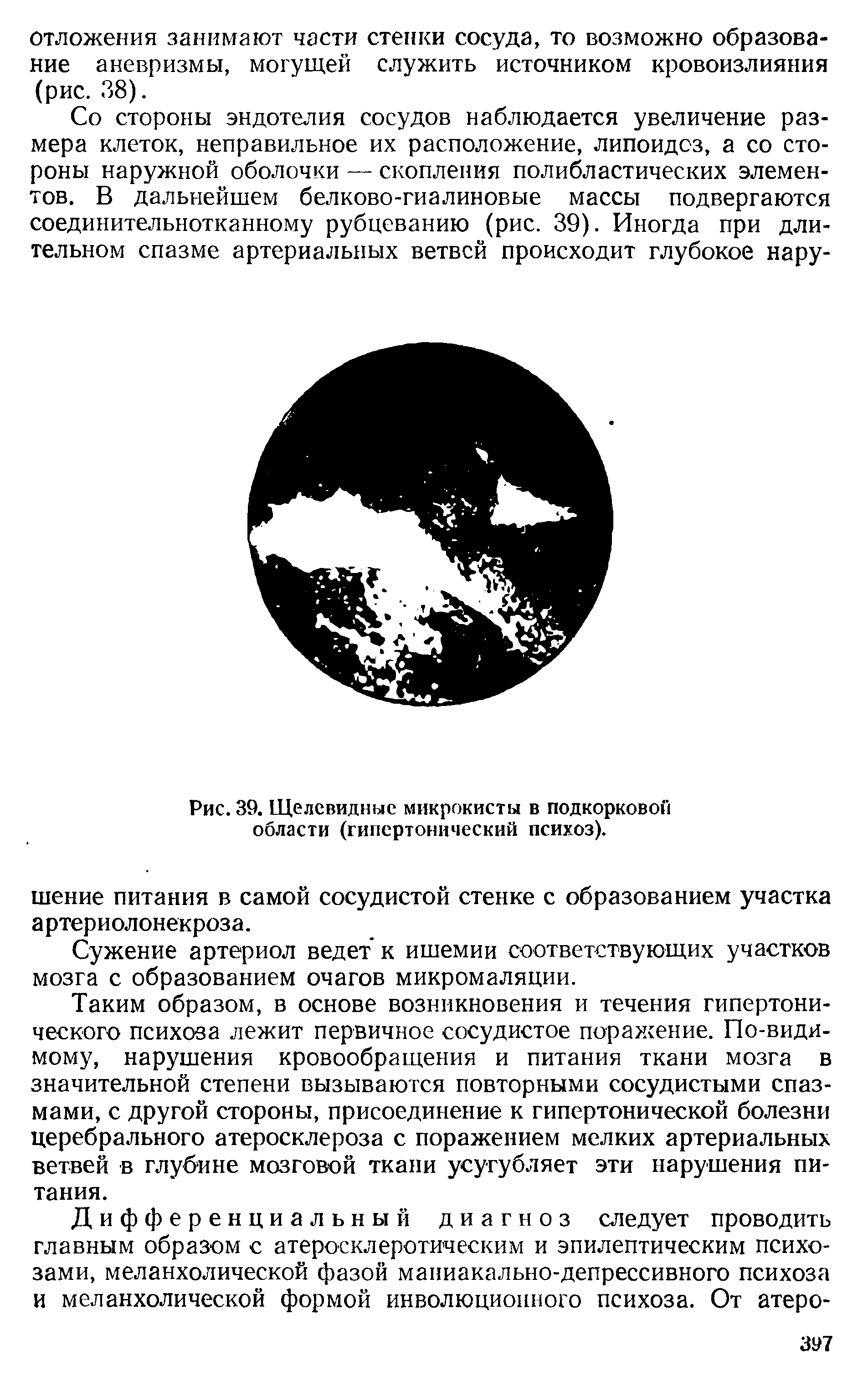 Рис. 39. ГЦелсвидные микрокисты в подкорковой области (гипертонический психоз).