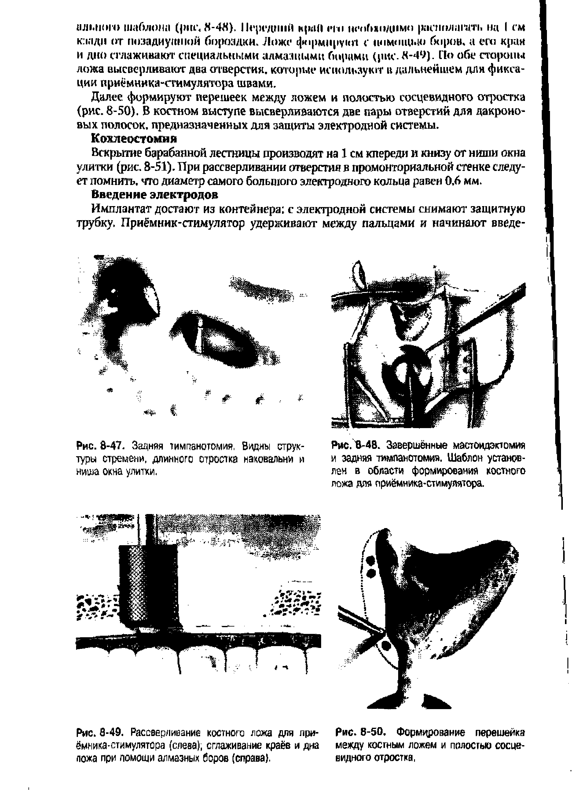 Рис. 8-47. Задняя тимпанотомия, Водны структуры стремени, длинного отростка наковальни и ниша окна улитки.