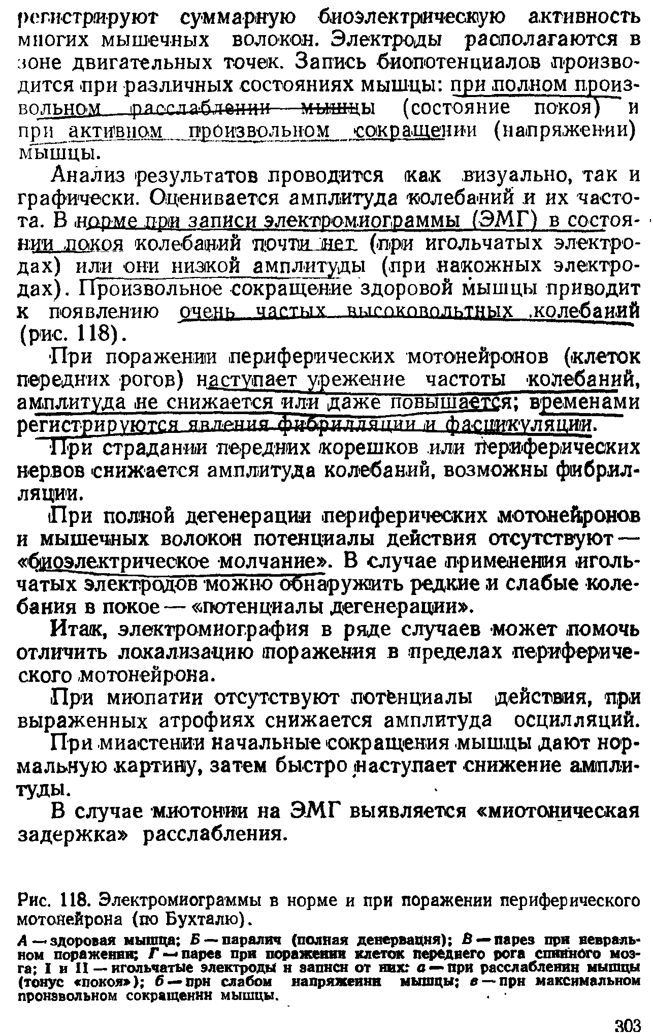 Рис. 118. Электромиограммы в норме и при поражении периферического мотонейрона (по Бухталю).