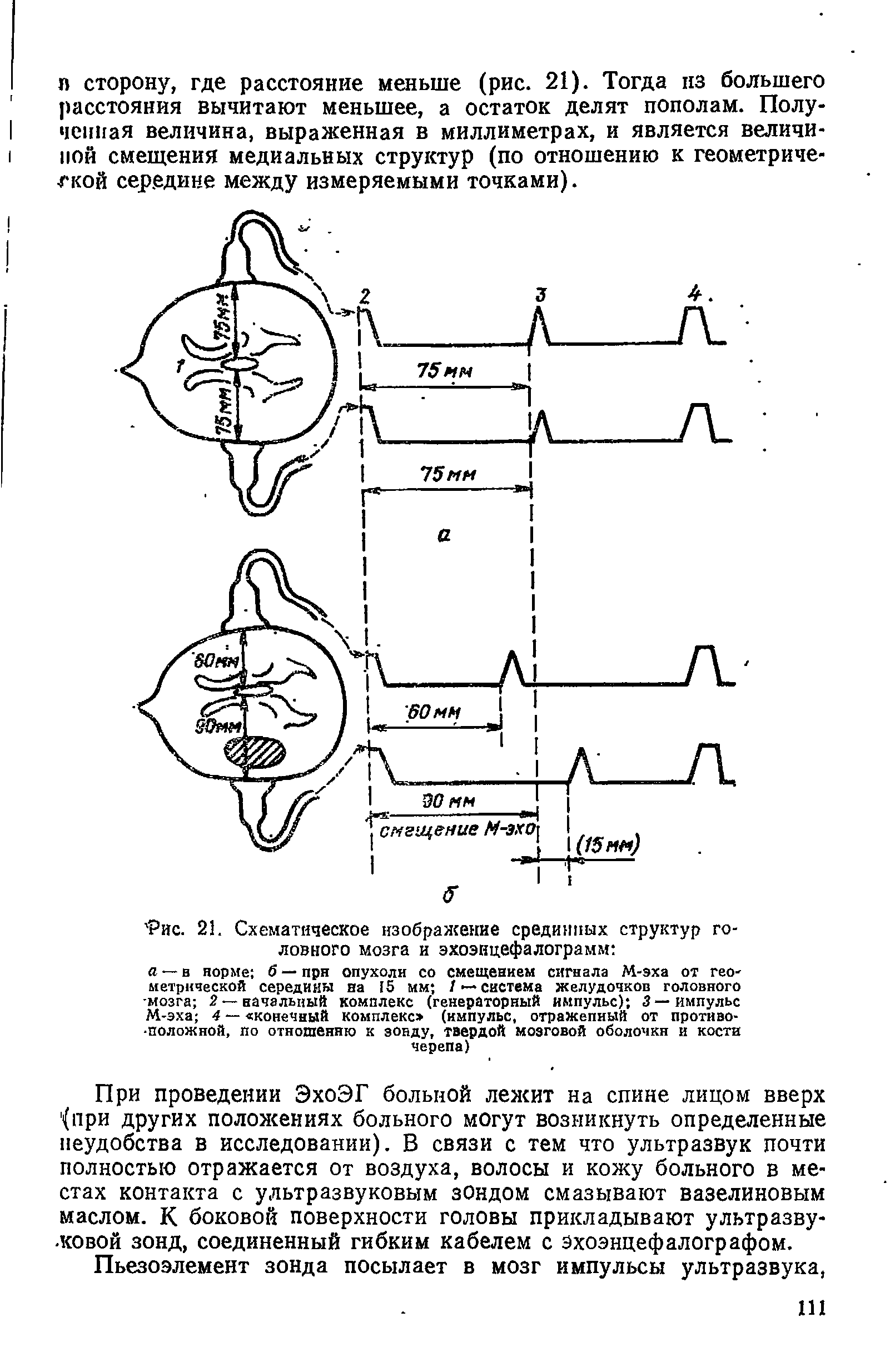 Рис. 21. Схематическое изображение срединных структур головного мозга и эхоэнцефалограмм ...
