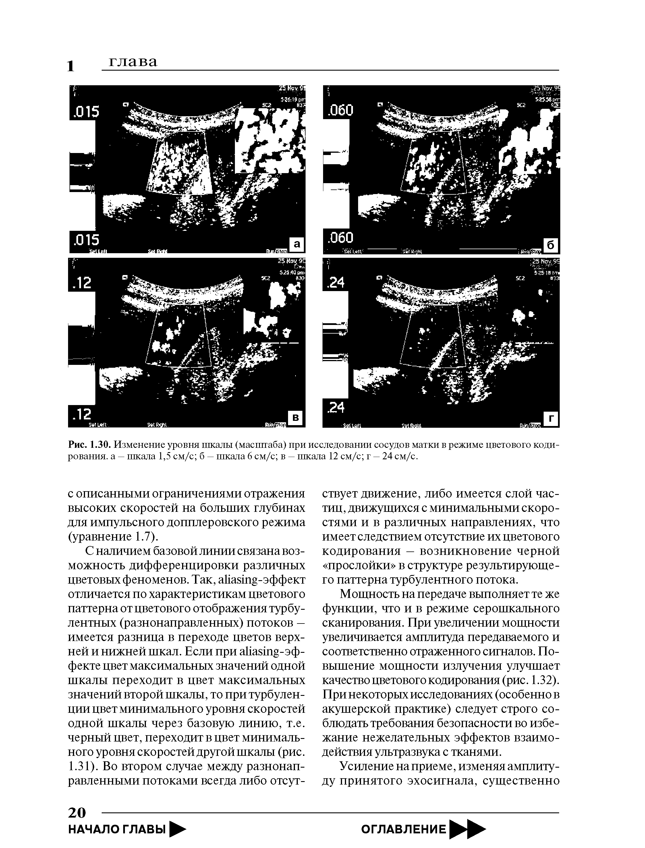 Рис. 1.30. Изменение уровня шкалы (масштаба) при исследовании сосудов матки в режиме цветового кодирования. а — шкала 1,5 см/с б — шкала 6 см/с в — шкала 12 см/с г — 24 см/с.