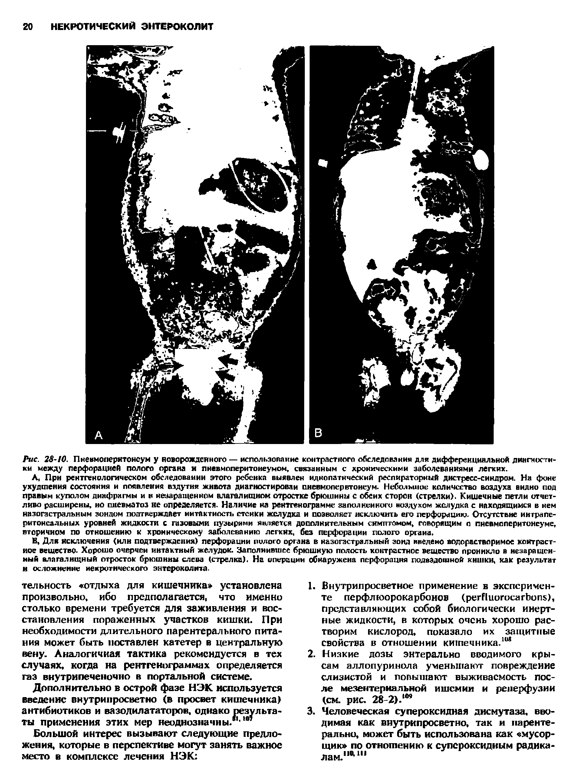 Рис. 28-10. Пневмопернтонсум у новорожденного — использование контрастного обследования для дифференциальной диагностики между перфорацией полого органа и пневмоперитонеумом, связанным с хроническими заболеваниями легких.