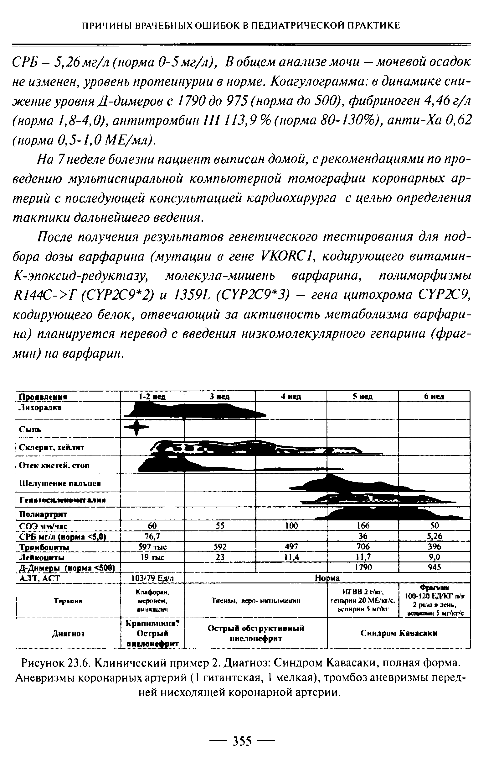 Рисунок 23.6. Клинический пример 2. Диагноз Синдром Кавасаки, полная форма. Аневризмы коронарных артерий (1 гигантская, 1 мелкая), тромбоз аневризмы передней нисходящей коронарной артерии.