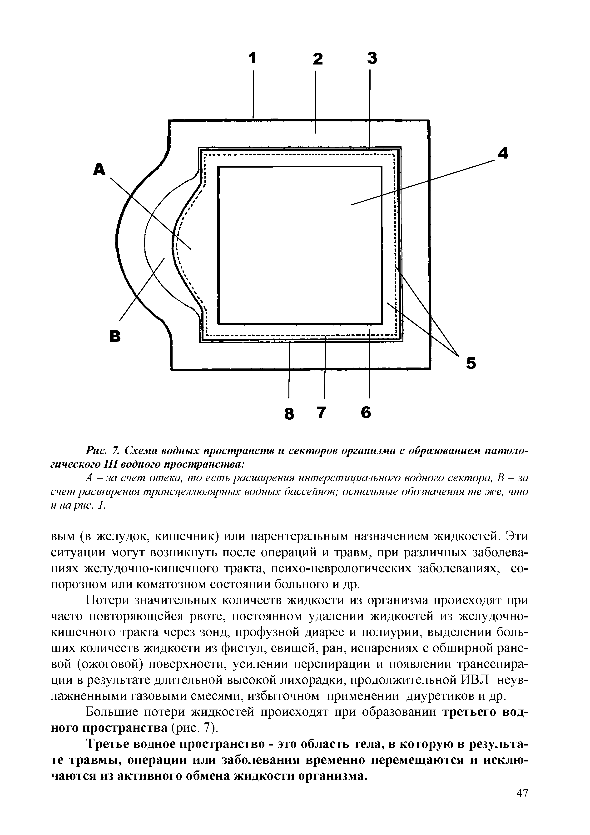 Рис. 7. Схема водных пространств и секторов организма с образованием патологического III водного пространства ...