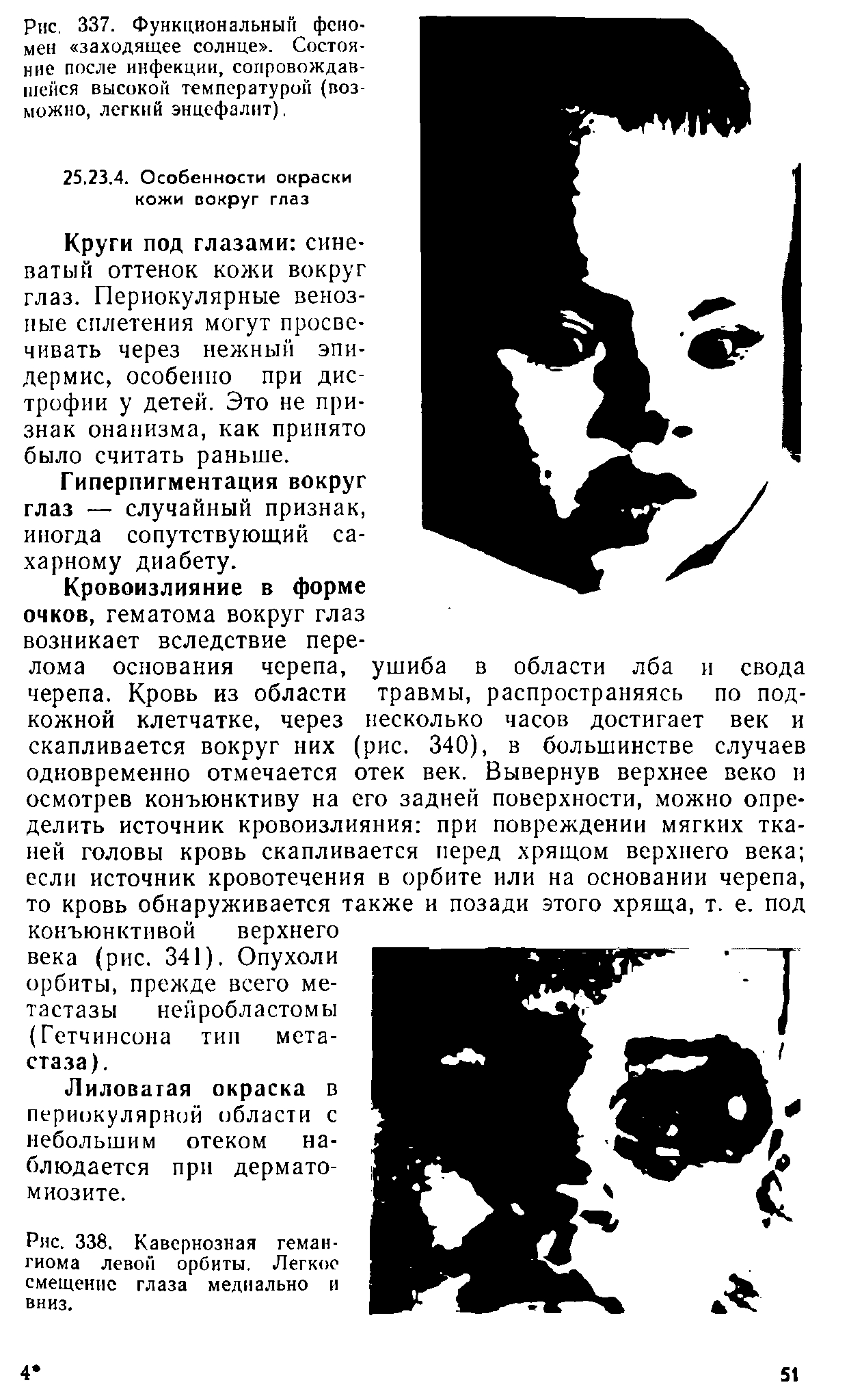 Рис. 338. Кавернозная гемангиома левой орбиты. Легкое смещение глаза медиально и вниз.