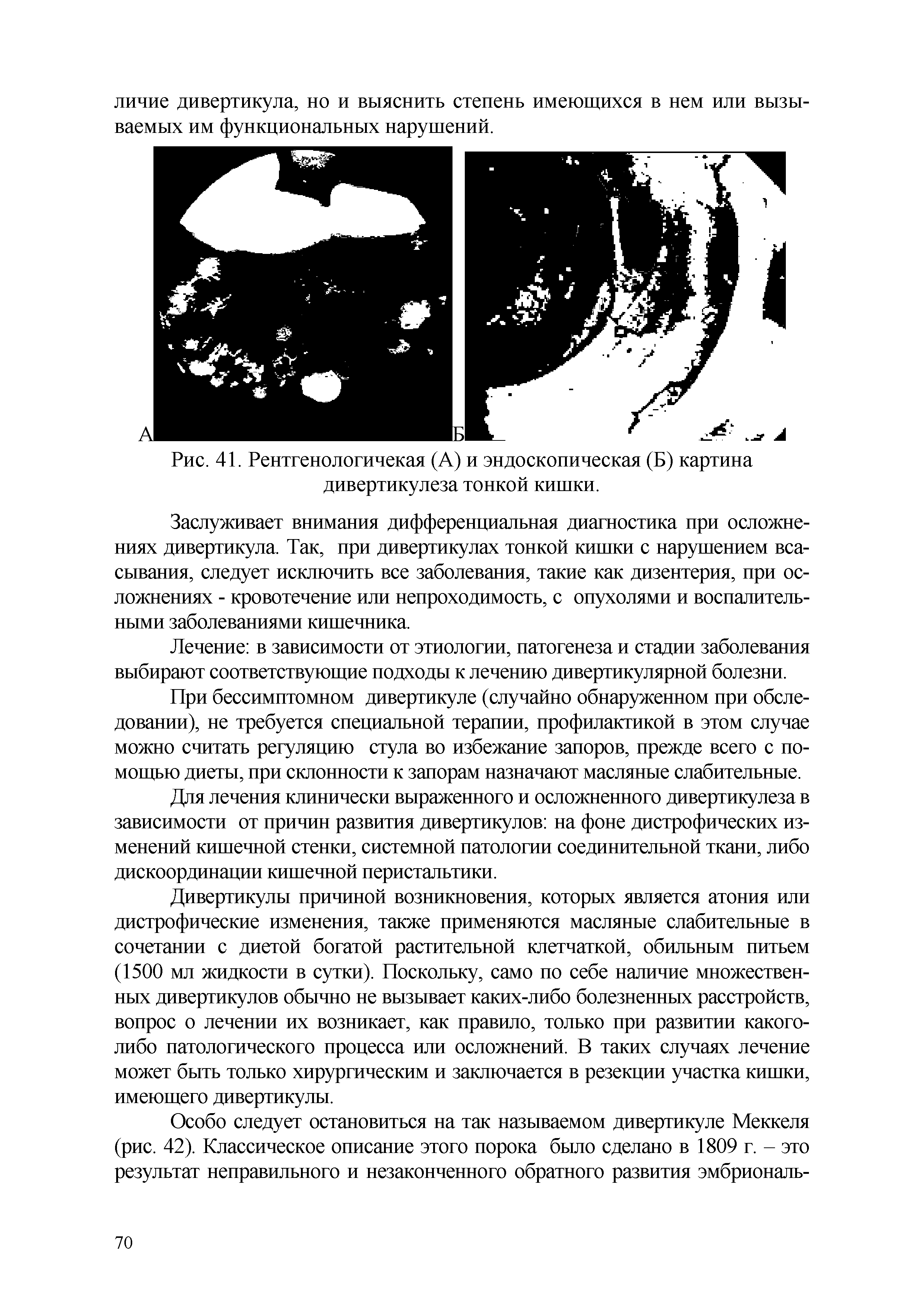 Рис. 41. Рентгенологичекая (А) и эндоскопическая (Б) картина дивертикулеза тонкой кишки.