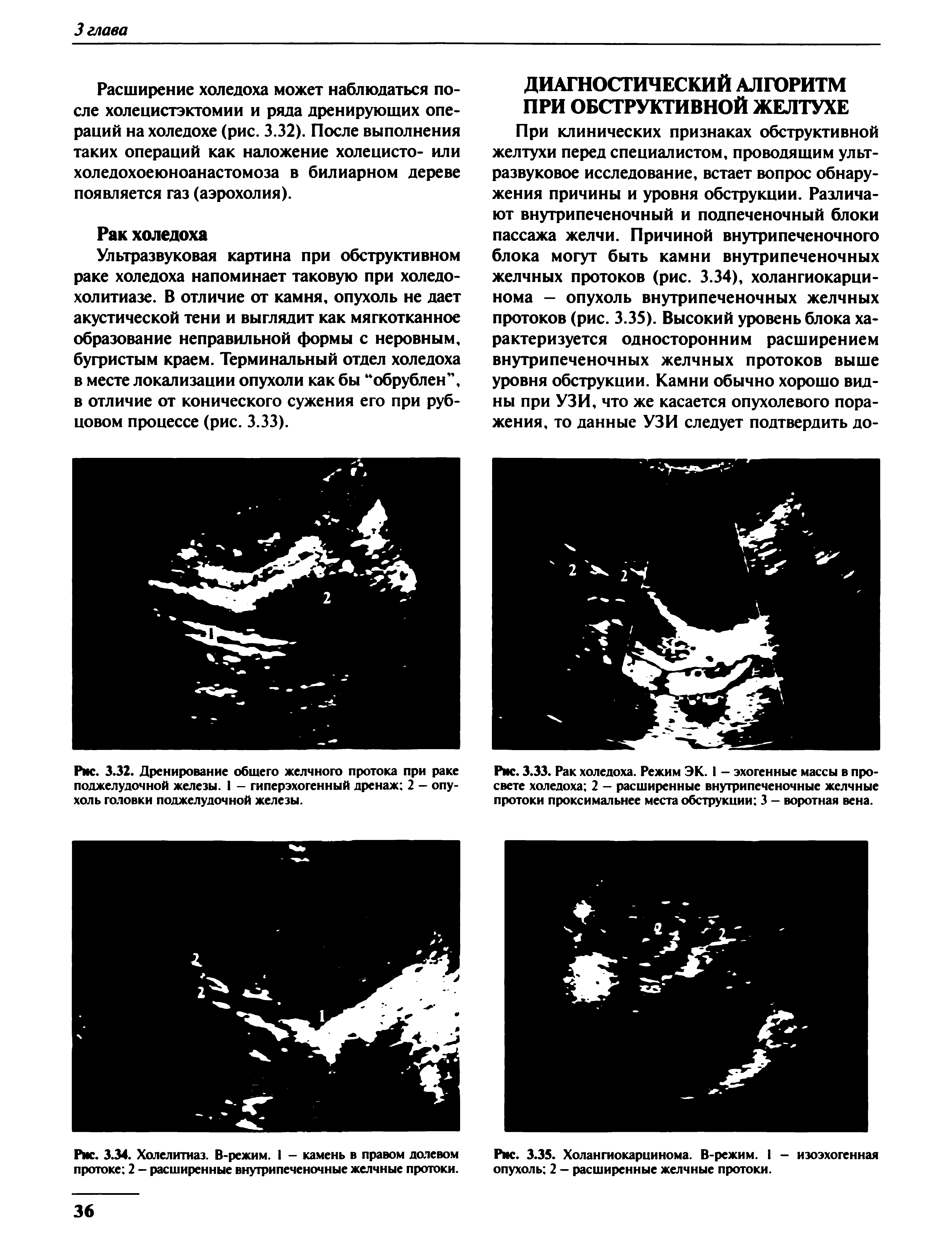 Рис. 3.33. Рак холедоха. Режим ЭК. I - эхогенные массы в просвете холедоха 2 - расширенные внутрипеченочные желчные протоки проксимальнее места обструкции 3 - воротная вена.