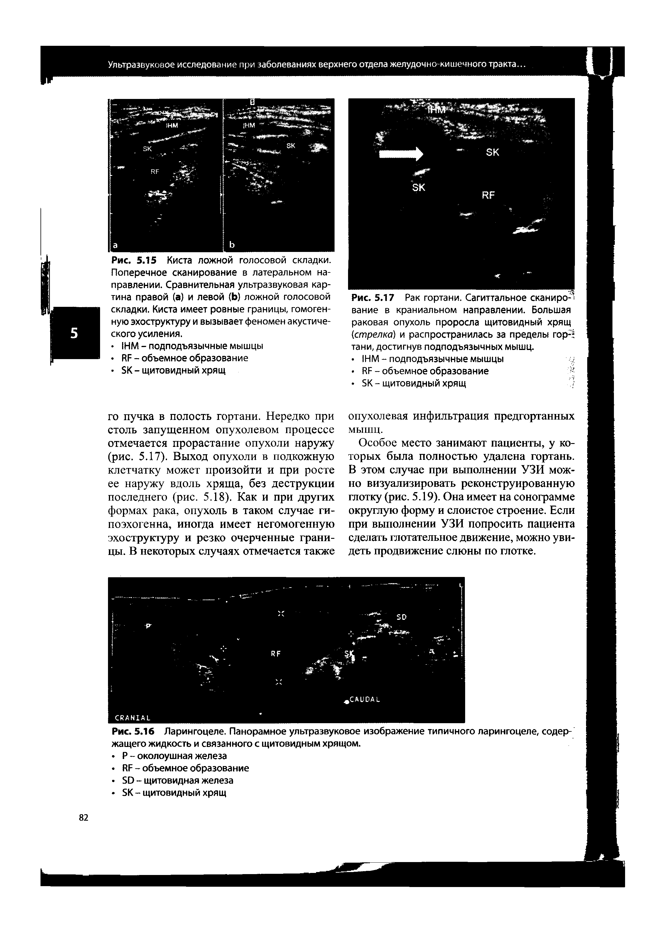 Рис. 5.15 Киста ложной голосовой складки. Поперечное сканирование в латеральном направлении. Сравнительная ультразвуковая картина правой (а) и левой (Ь) ложной голосовой складки. Киста имеет ровные границы, гомогенную эхоструктуру и вызывает феномен акустиче-...