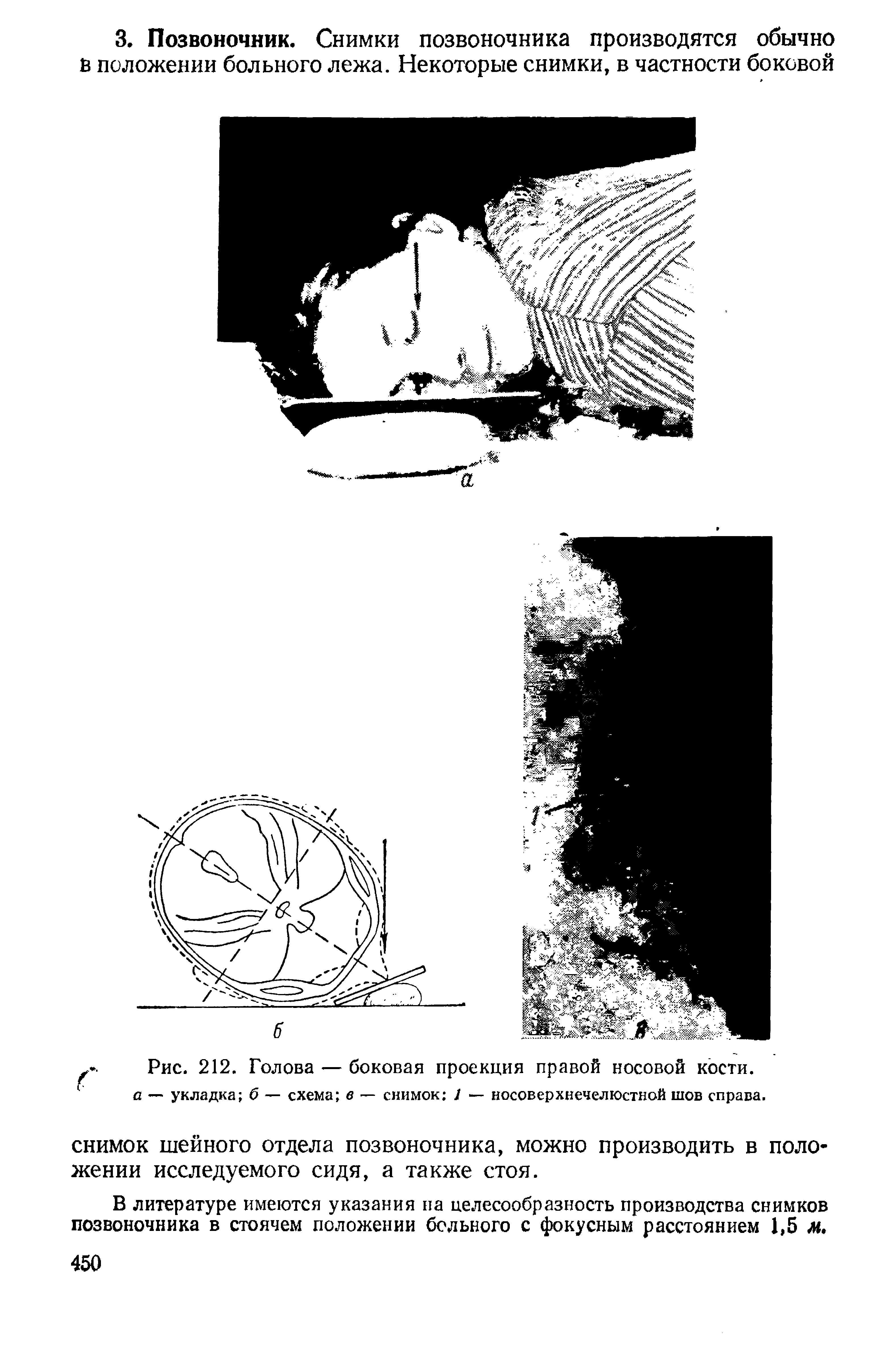 Рис. 212. Голова — боковая проекция правой носовой кости. а — укладка б — схема в — снимок / — носоверхнечелюстной шов справа.