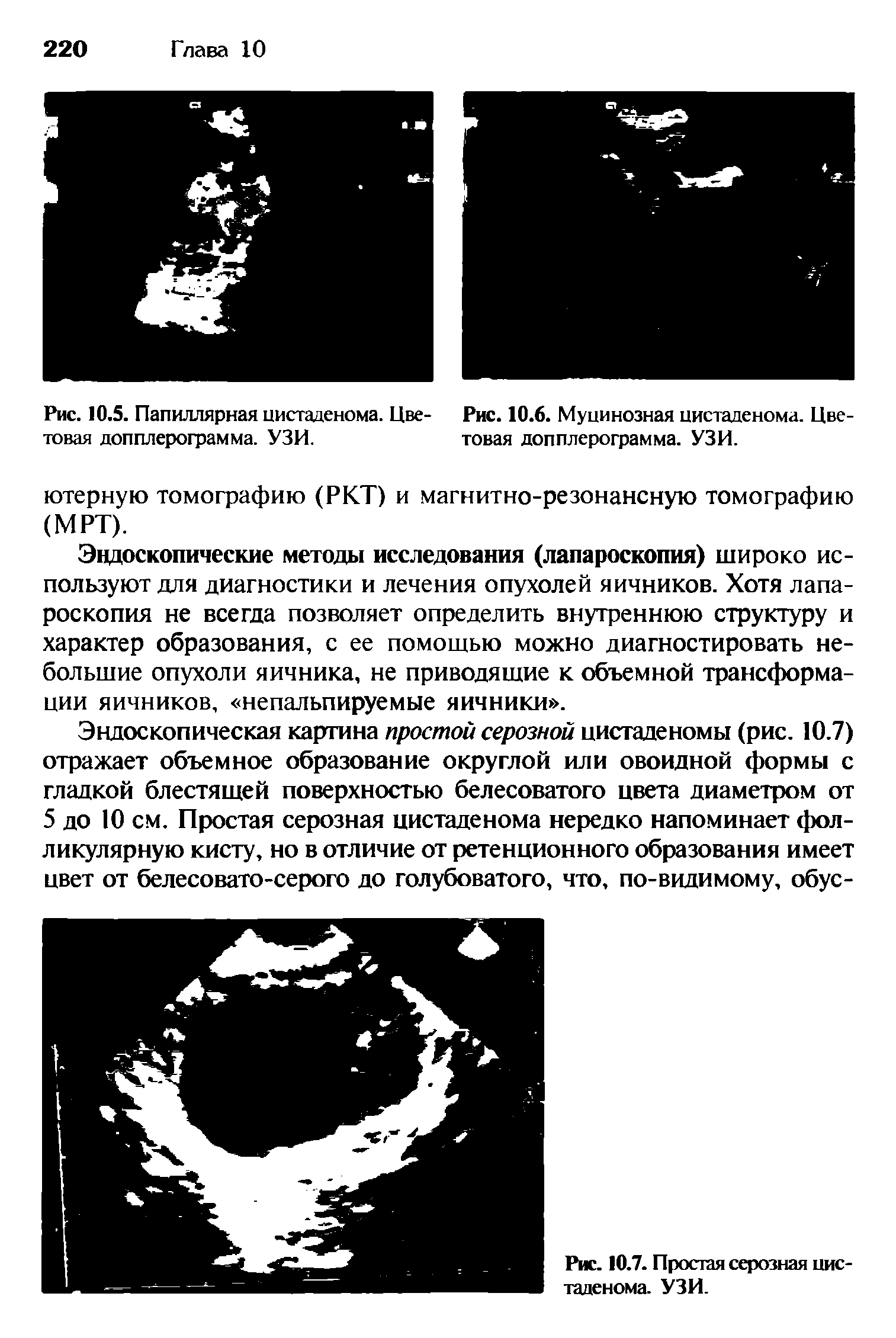 Рис. 10.5. Папиллярная цистаденома. Цве- Рис. 10.6. Муцинозная цистаденома. Цветовая допплерограмма. УЗИ. товая допплерограмма. УЗИ.