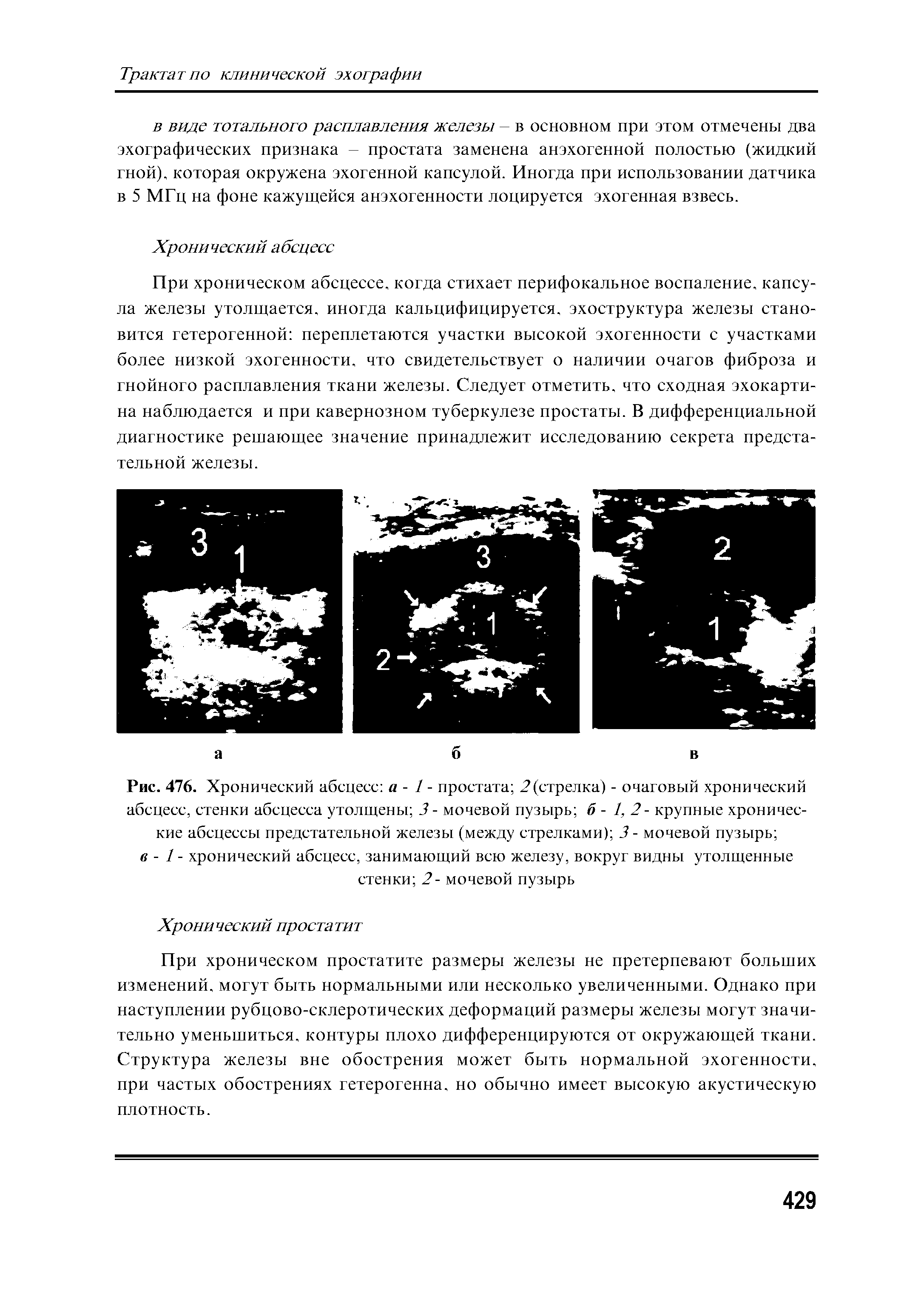 Рис. 476. Хронический абсцесс а - 1 - простата 2(стрелка) - очаговый хронический абсцесс, стенки абсцесса утолщены 3 - мочевой пузырь б - 1, 2- крупные хронические абсцессы предстательной железы (между стрелками) 3 - мочевой пузырь ...