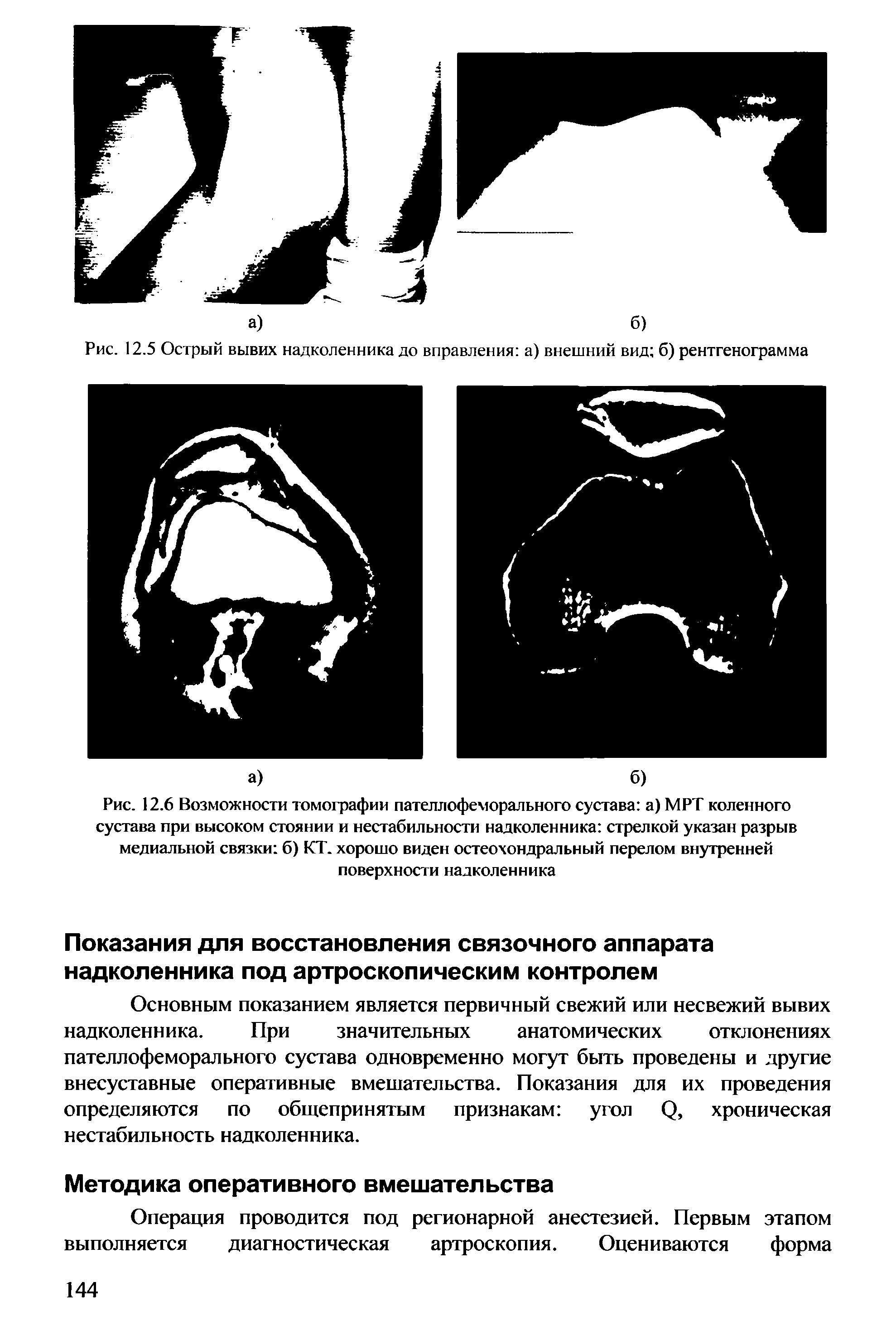 Рис. 12.6 Возможности томографии пателлофеморального сустава а) МРТ коленного сустава при высоком стоянии и нестабильности надколенника стрелкой указан разрыв медиальной связки б) КТ. хорошо виден остеохондральный перелом внутренней поверхности надколенника...