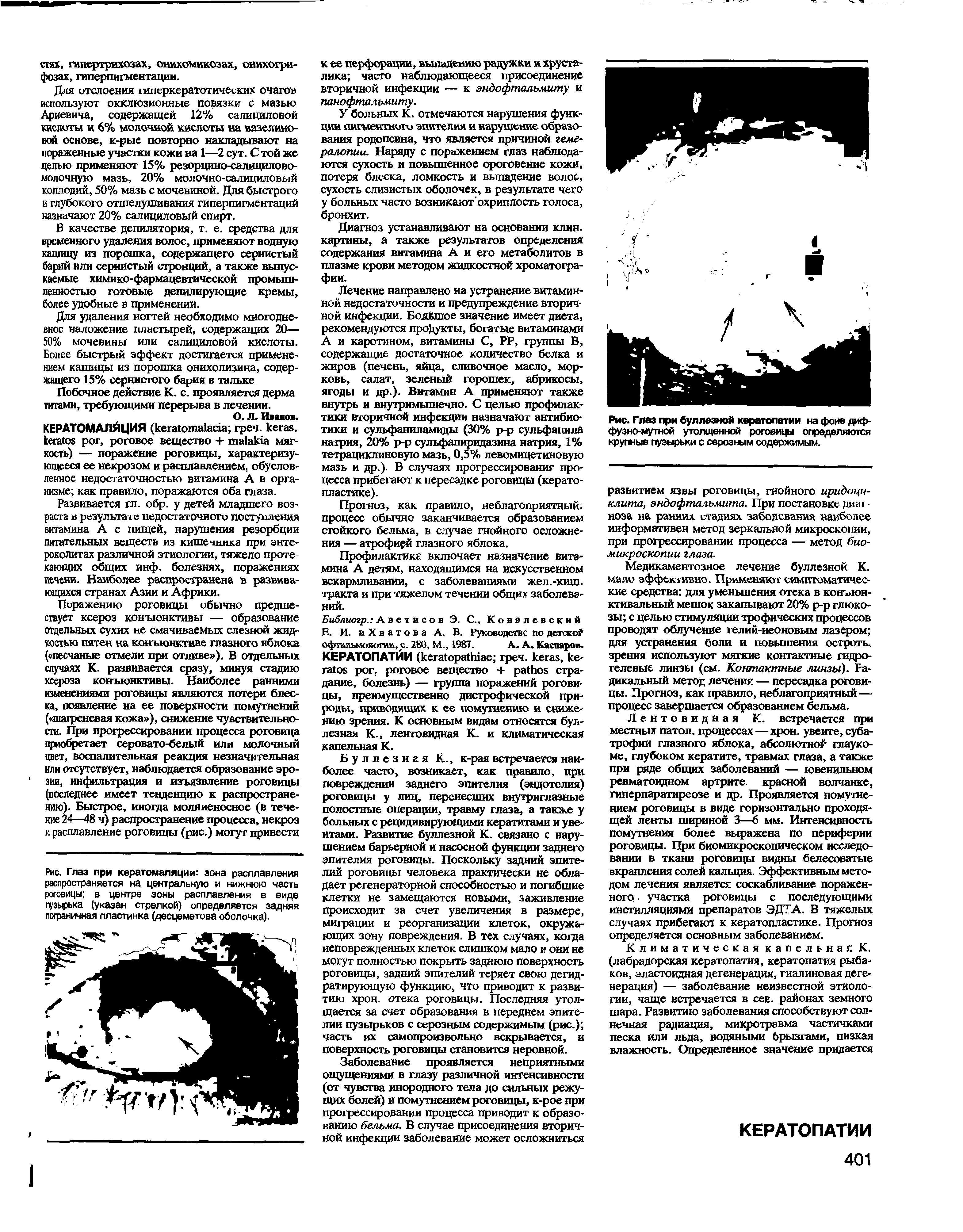 Рис. Глаз при буллезной кератопатии на фоне диффузно-мутной утолщенной роговицы определяются крупные пузырьки с серозным содержимым.