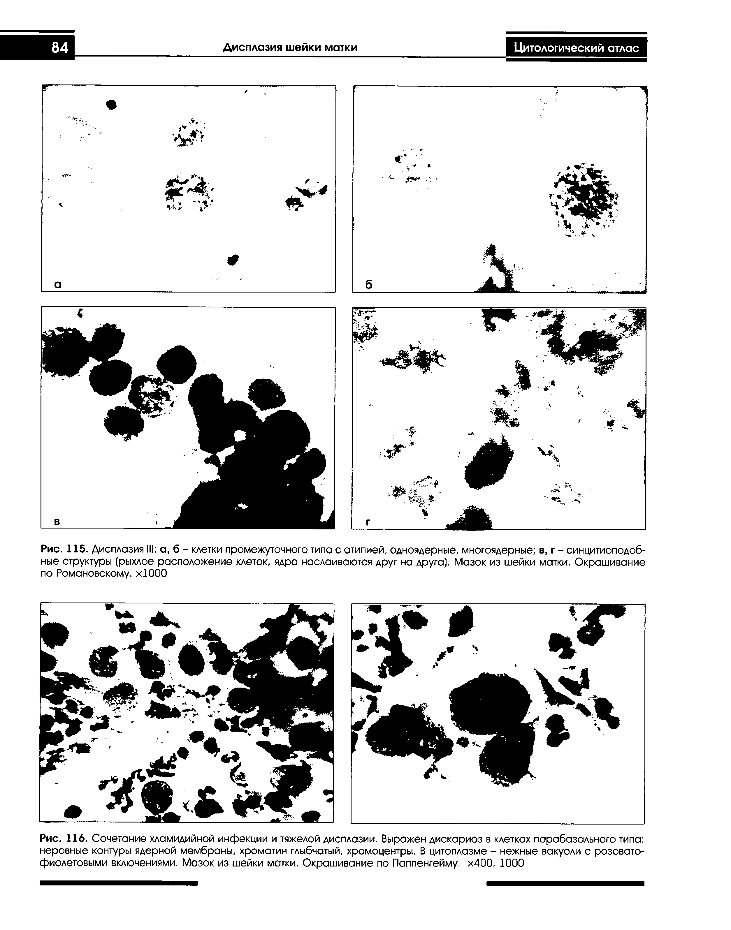 Рис. 115. Дисплазия III а, б - клетки промежуточного типа с атипией, одноядерные, многоядерные в, г - синцитиоподоб-ные структуры (рыхлое расположение клеток, ядра наслаиваются друг на друга). Мазок из шейки матки. Окрашивание по Романовскому. хЮОО...