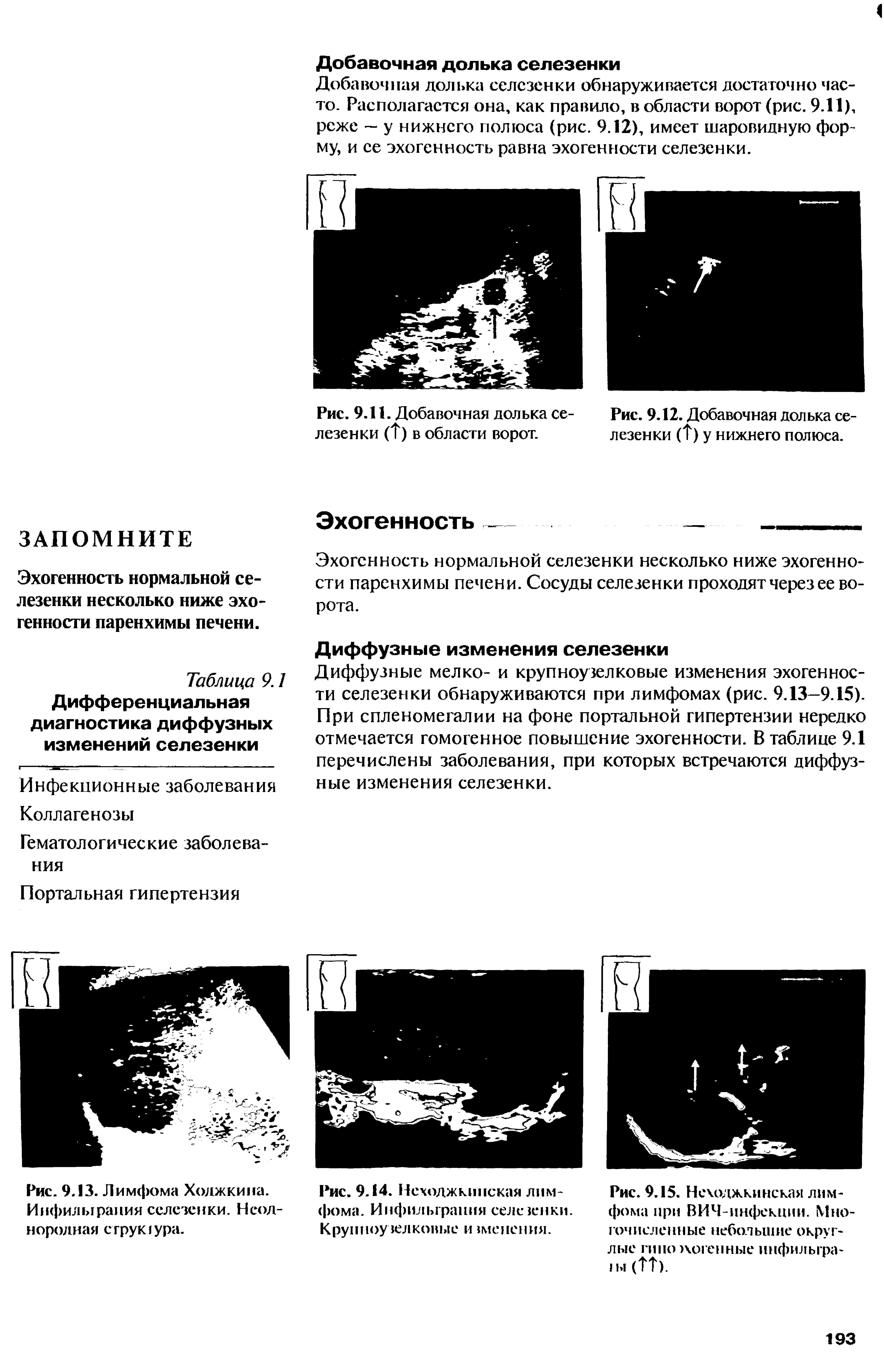 Рис. 9.15. Неходжкипская лимфома при ВИЧ-инфекции. Многочисленные небольшие округлые гиио посевные ннфилыра-1ы (ТТ).