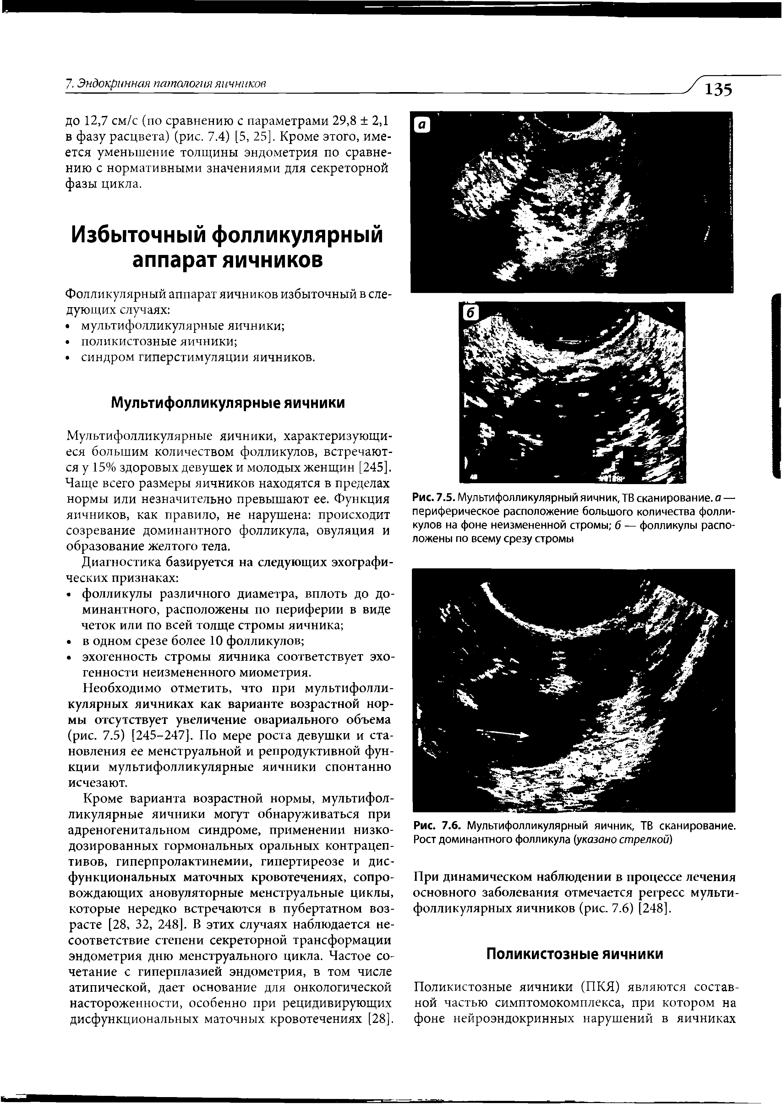 Рис. 7.5. Мультифолликулярный яичник, ТВ сканирование, а — периферическое расположение большого количества фолликулов на фоне неизмененной стромы б — фолликулы расположены по всему срезу стромы...