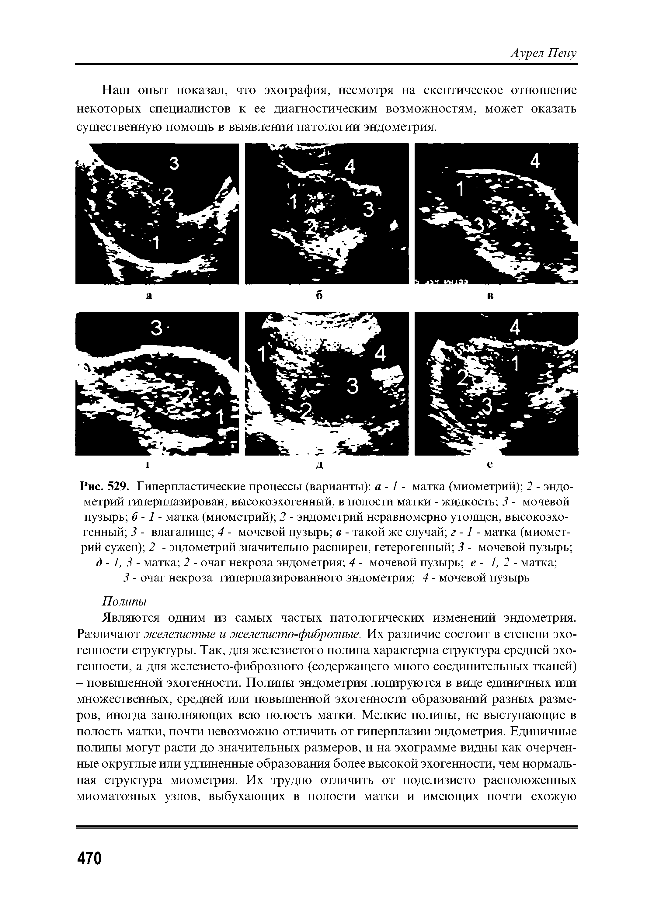 Рис. 529. Гиперпластические процессы (варианты) а -1 - матка (миометрий) 2 - эндометрий гиперплазирован, высокоэхогенный, в полости матки - жидкость 3 - мочевой пузырь б -1 - матка (миометрий) 2 - эндометрий неравномерно утолщен, высокоэхогенный 3 - влагалище 4 - мочевой пузырь в - такой же случай г -1 - матка (миометрий сужен) 2 - эндометрий значительно расширен, гетерогенный 3 - мочевой пузырь д -1, 3 - матка 2 - очаг некроза эндометрия 4 - мочевой пузырь е - 1,2- матка ...