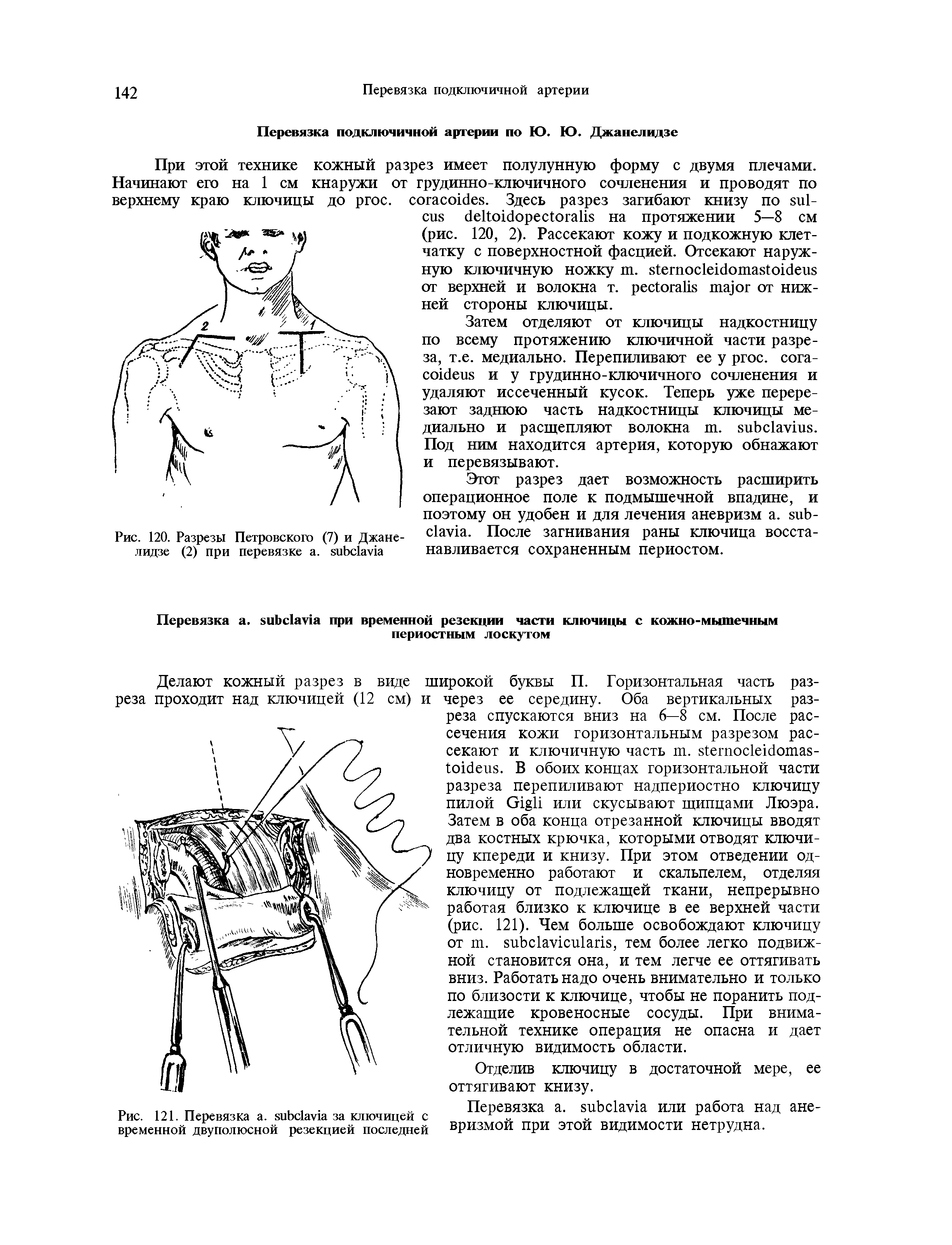 Рис. 121. Перевязка . за ключицей с временной двуполюсной резекцией последней...