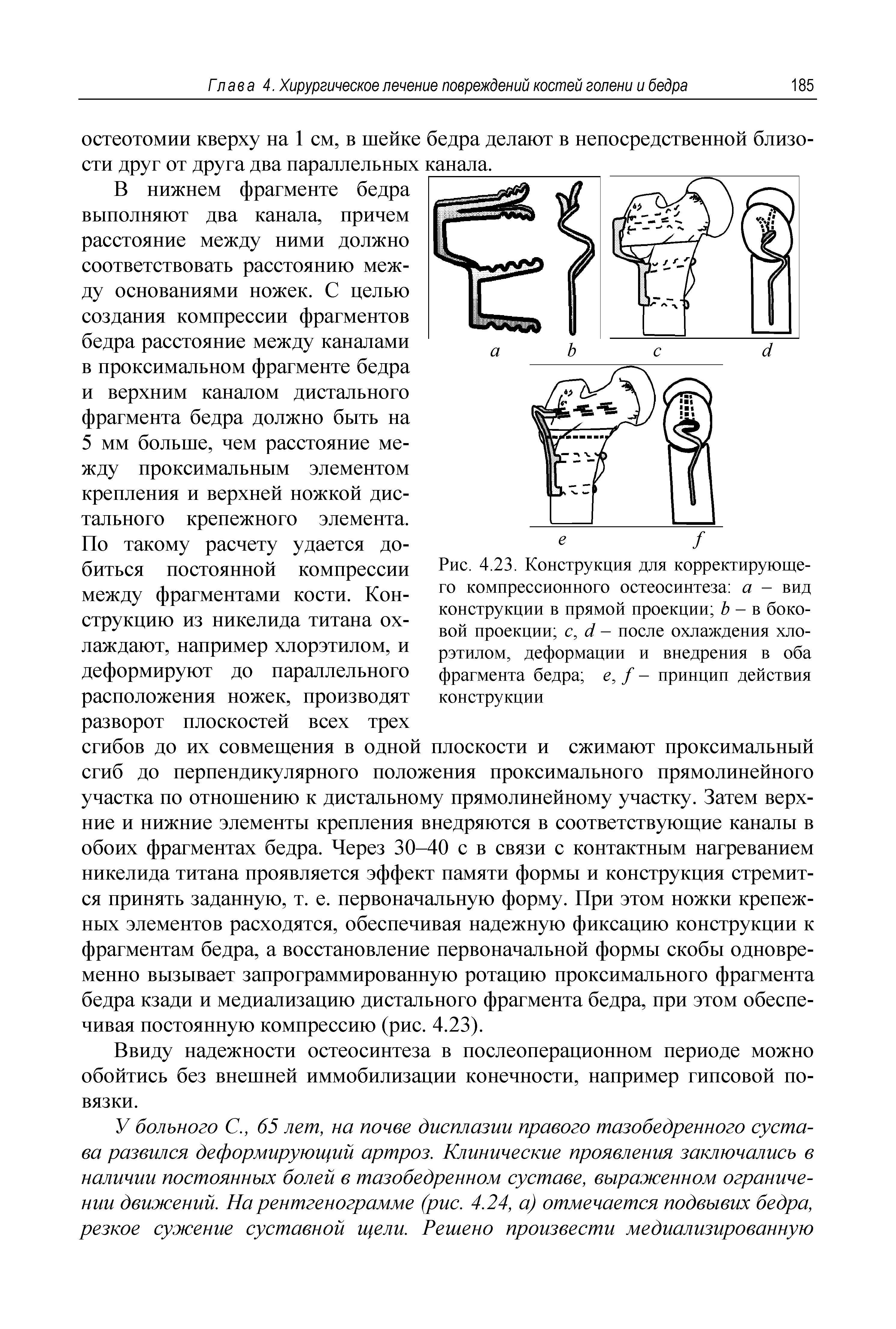 Рис. 4.23. Конструкция для корректирующего компрессионного остеосинтеза а - вид конструкции в прямой проекции Ъ - в боковой проекции с, с1 - после охлаждения хло-рэтилом, деформации и внедрения в оба фрагмента бедра е, / - принцип действия конструкции...